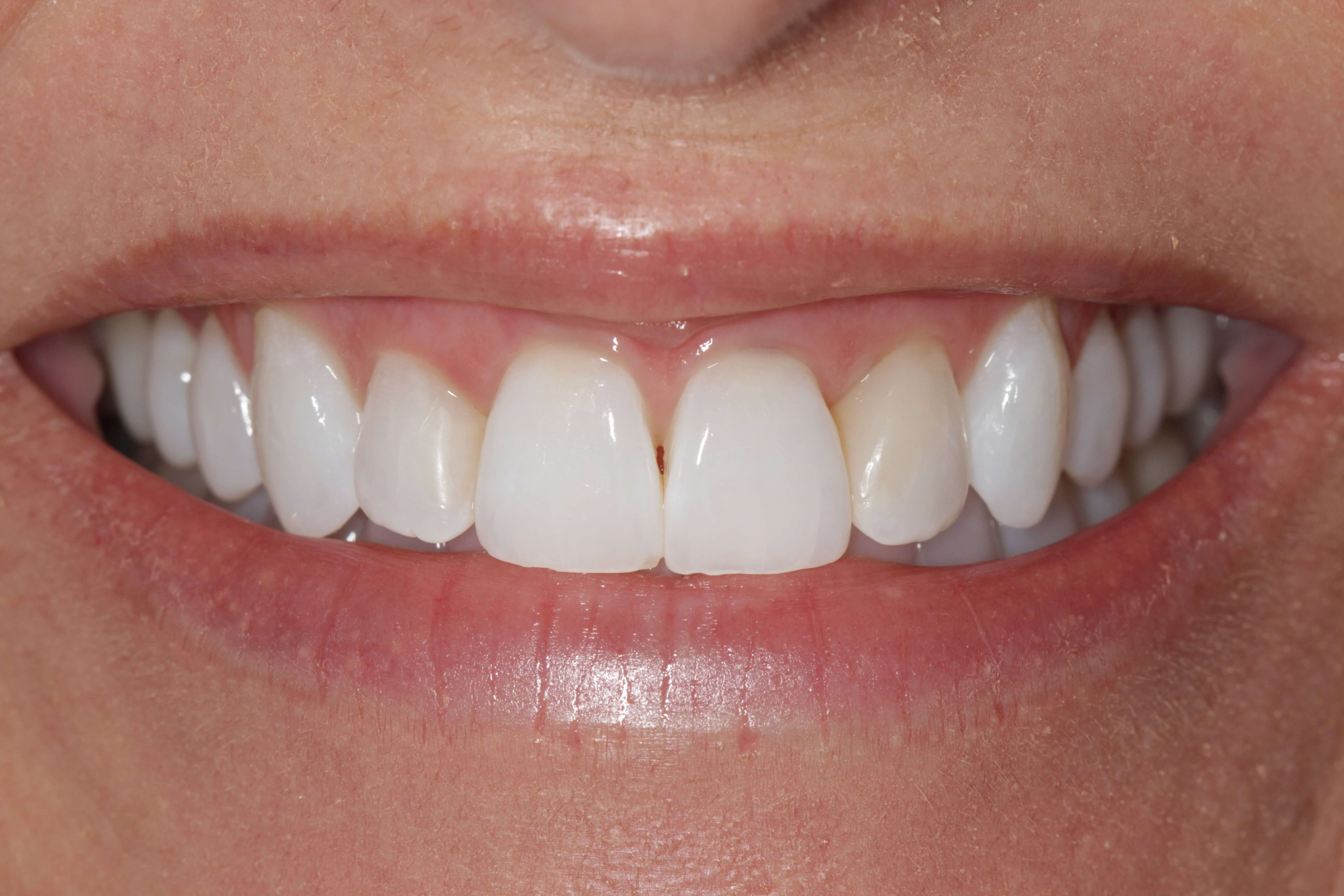 Conservative Smile Makeover Before Conservative Smile Makeover Before