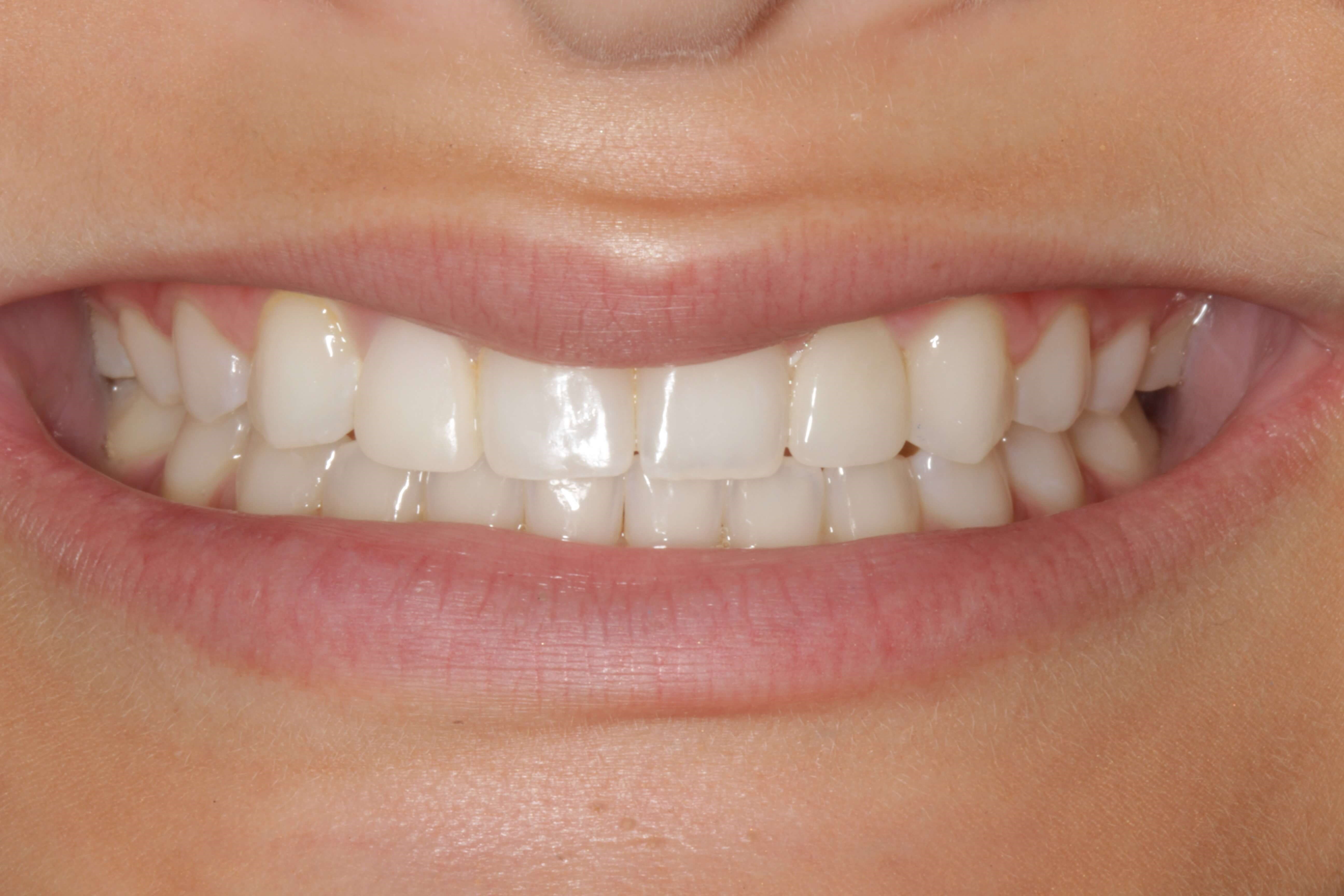 Smile Makeover B & A After Smile Makeover B & A After