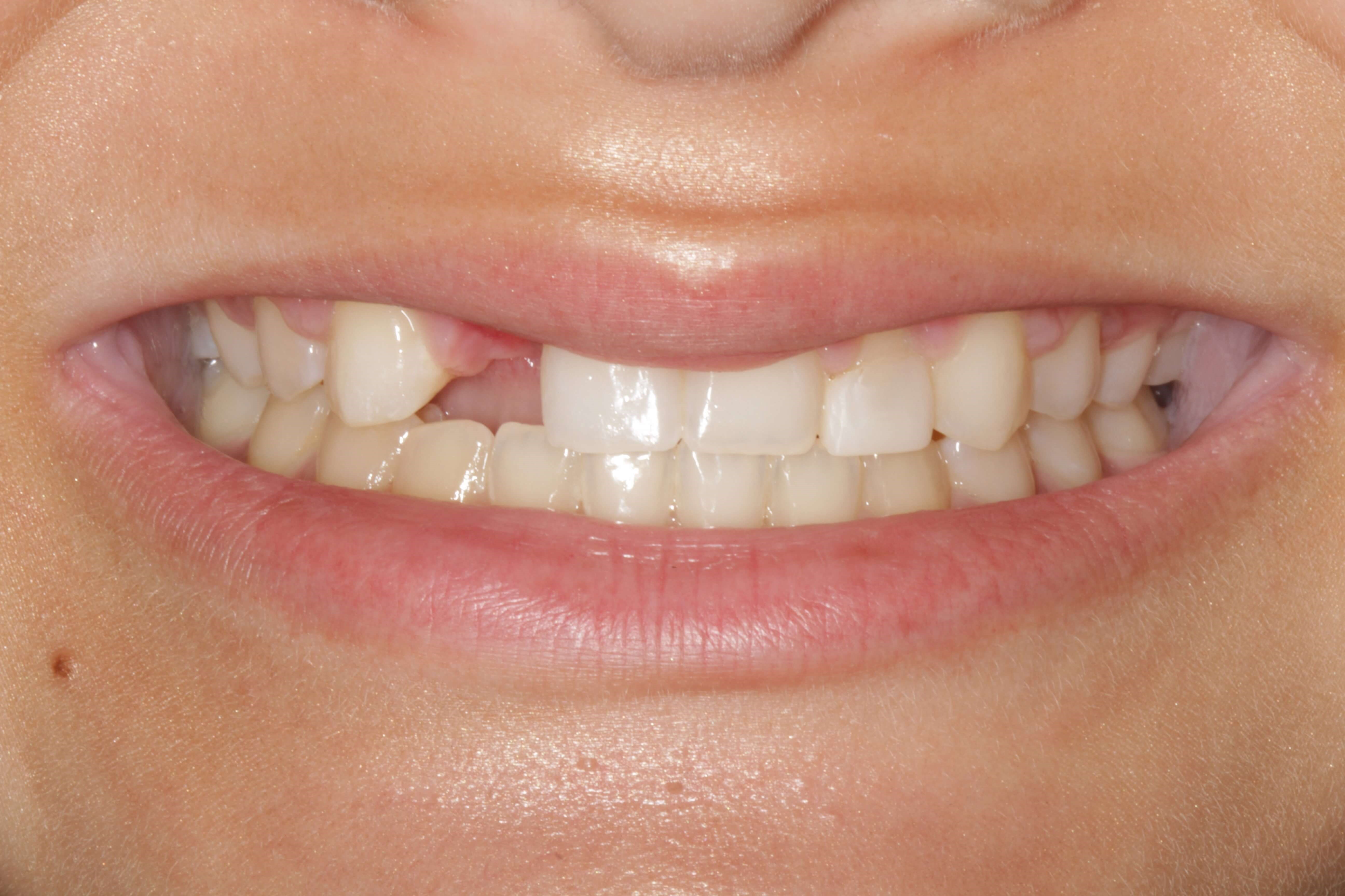 Smile Makeover B & A Before Smile Makeover B & A Before