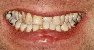 Smile Makeover B & A Before Smile Makeover B & A Before