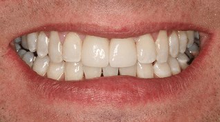 Smile Makeover B & A After Smile Makeover B & A After