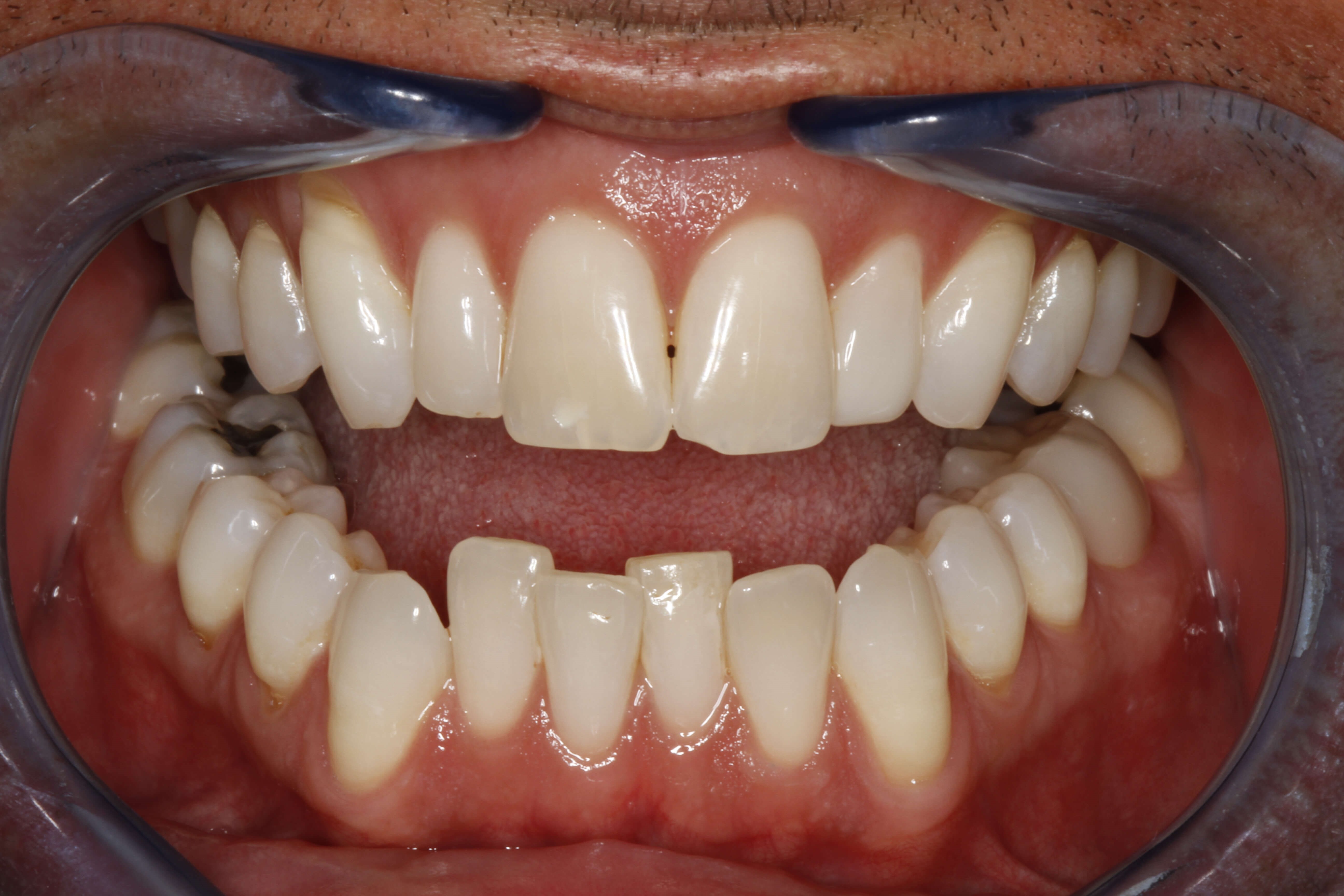 Smile Makeover B & A Before Smile Makeover B & A Before