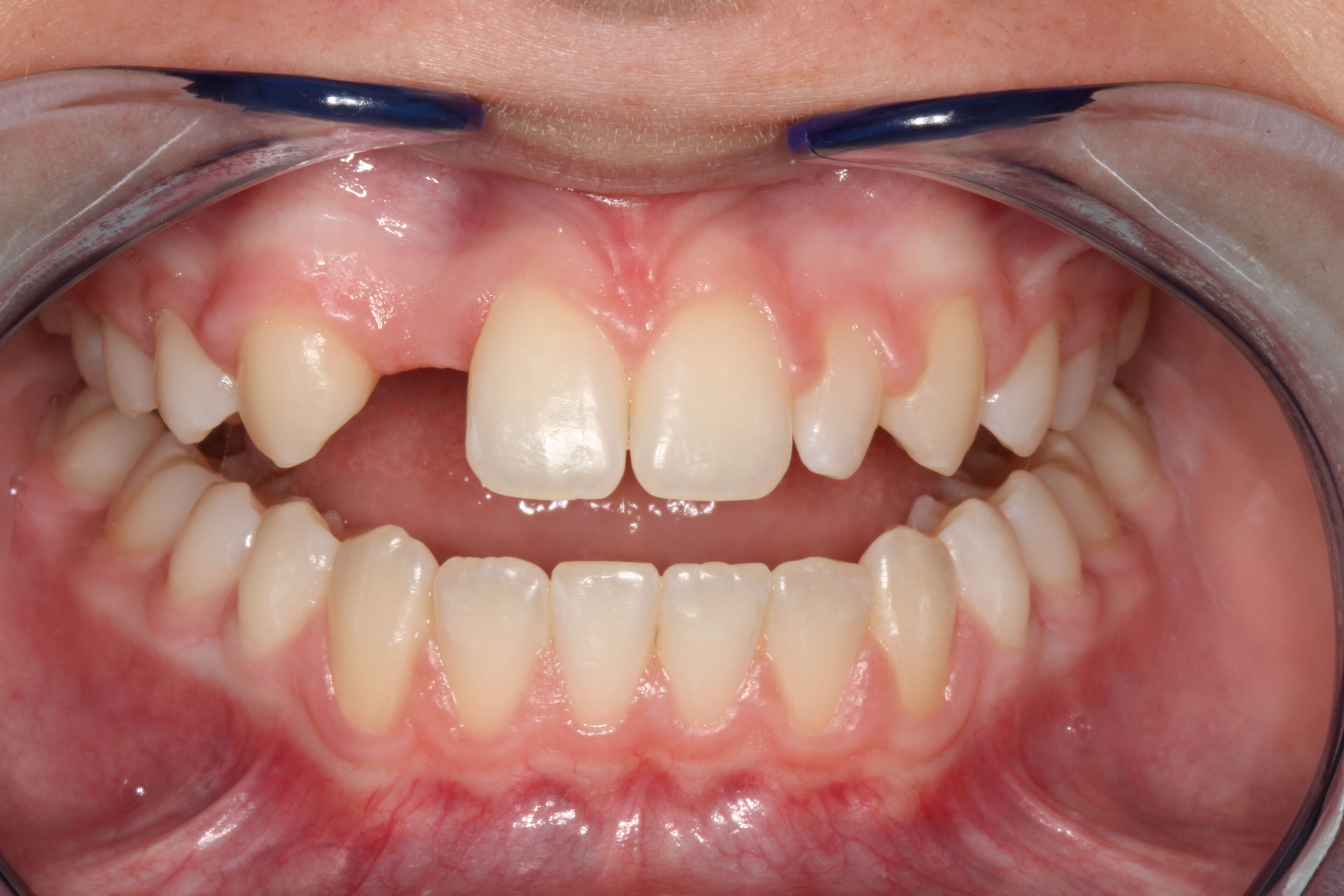 Smile Makeover B & A Before Smile Makeover B & A Before