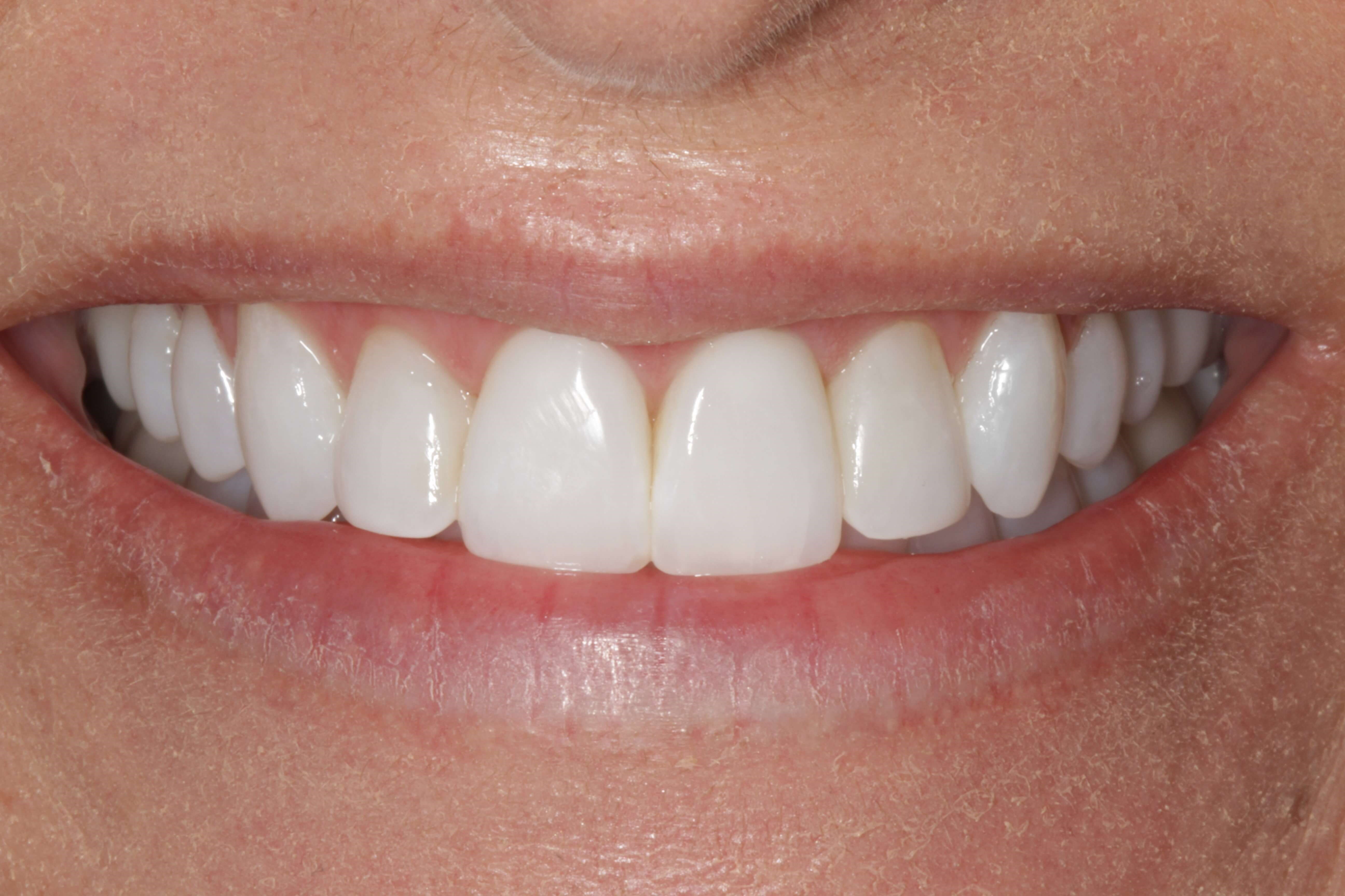 Conservative Smile Makeover After