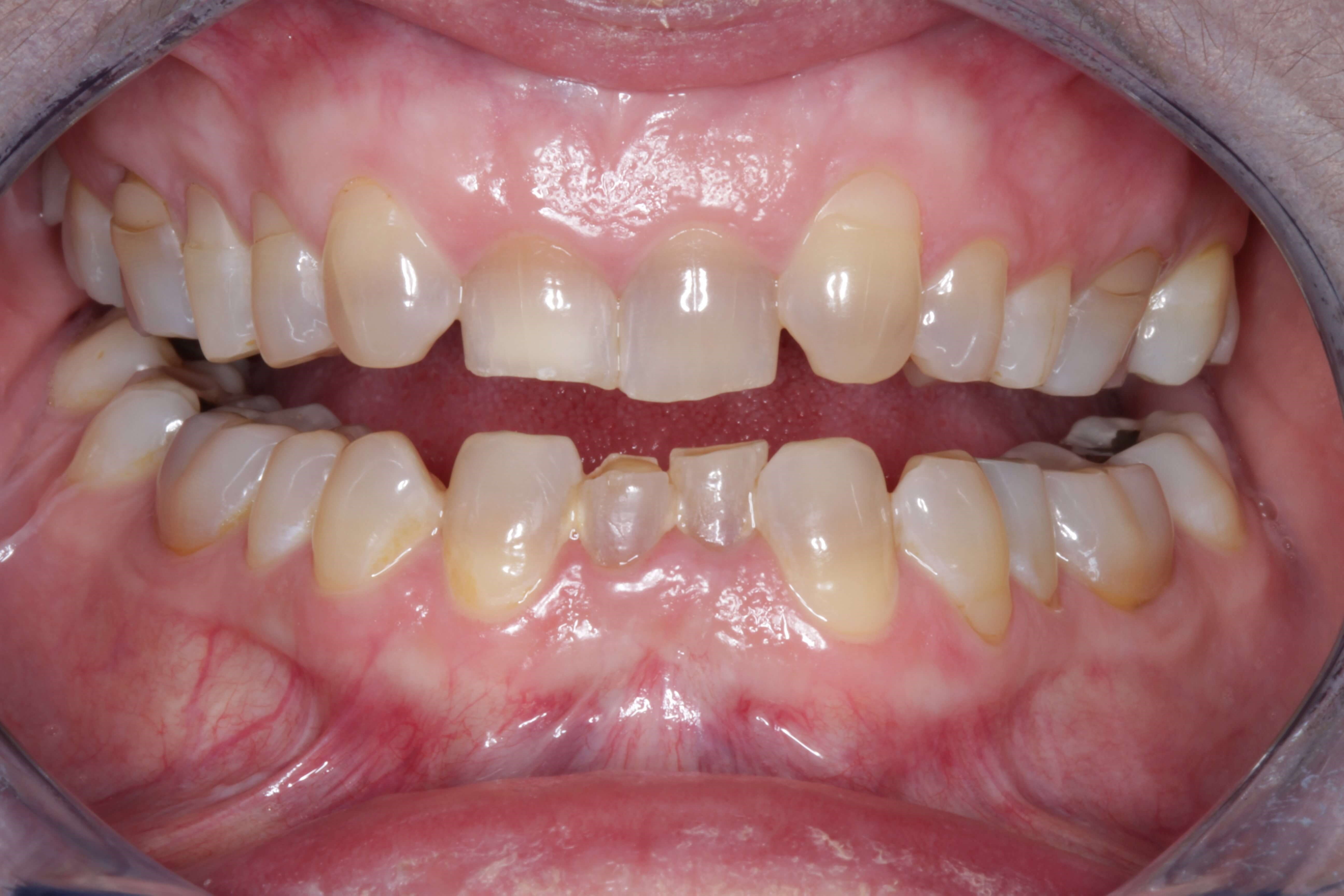 Orthodontic before and after Before Orthodontics