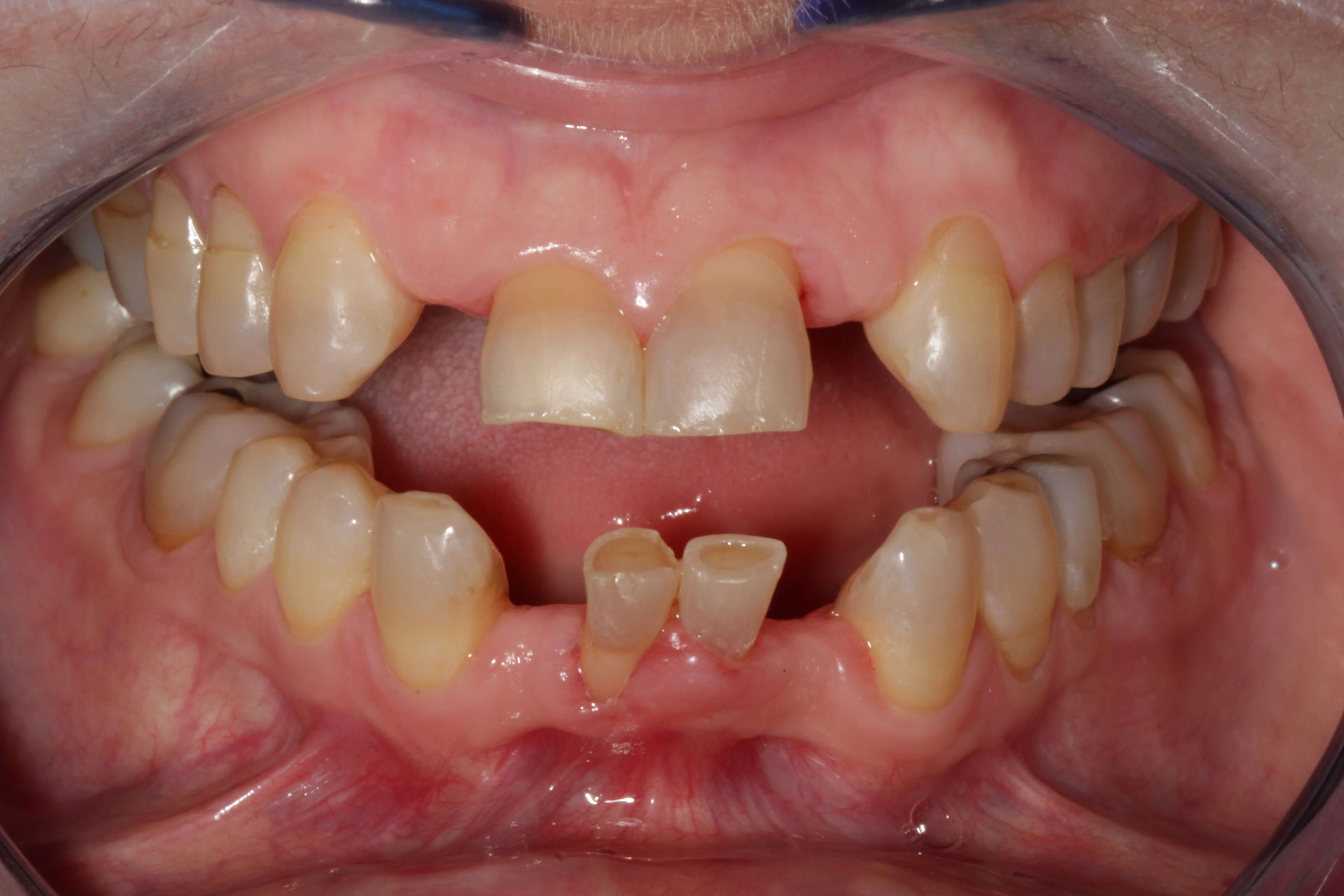 Orthodontic before and after After Orthodontics