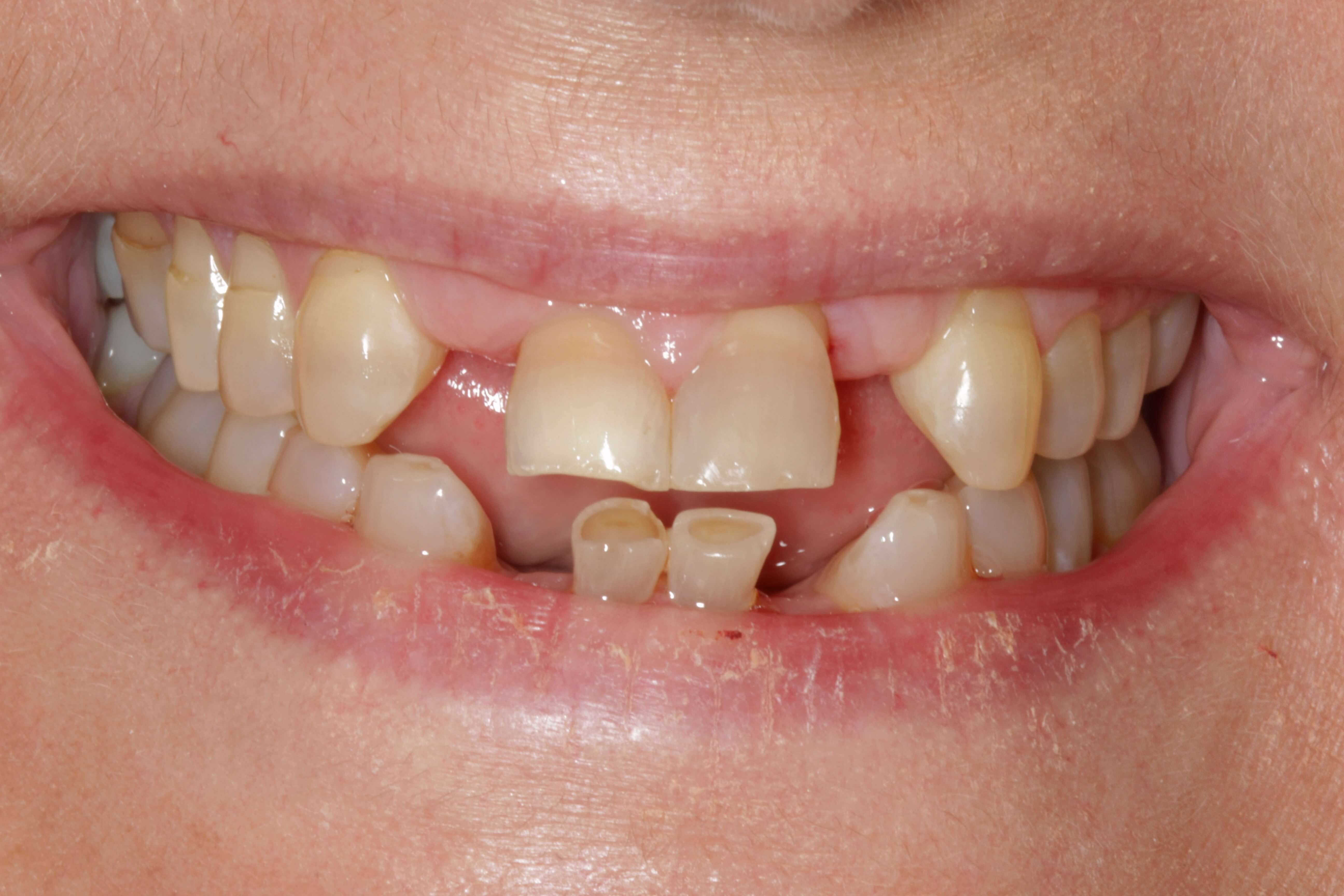 Cosmetic Work before and after Before