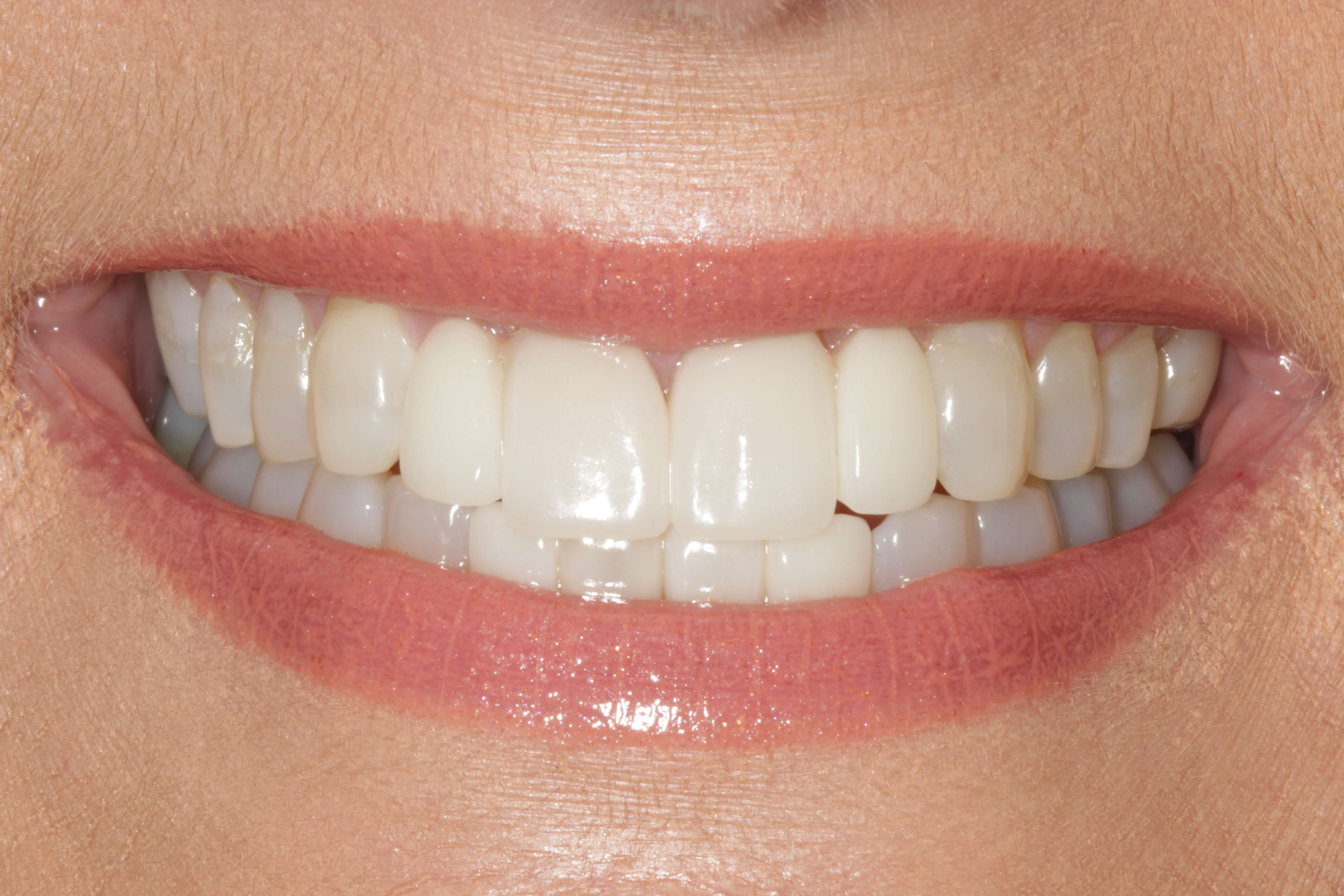 Cosmetic Work before and after After