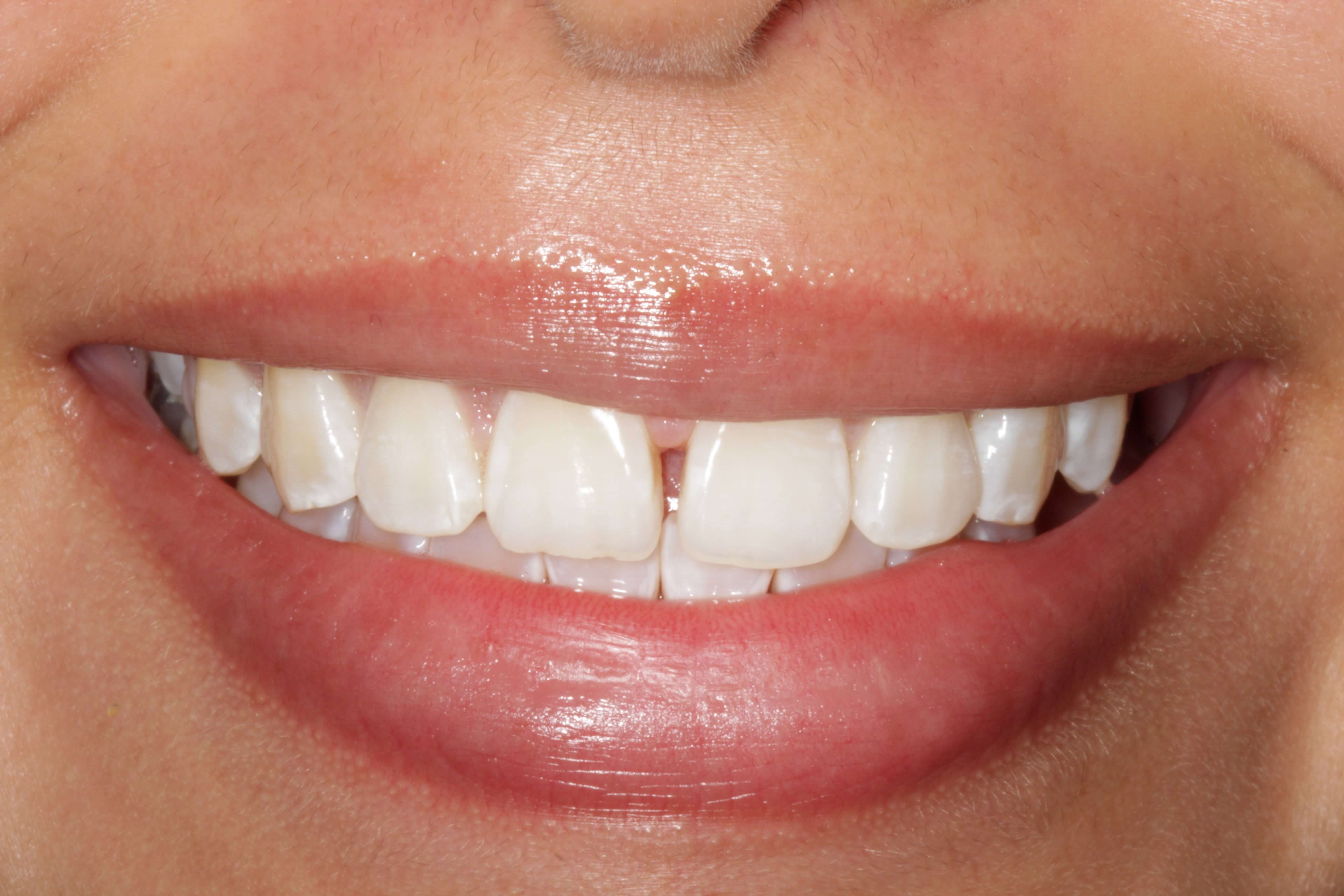 Before and After Photos Before