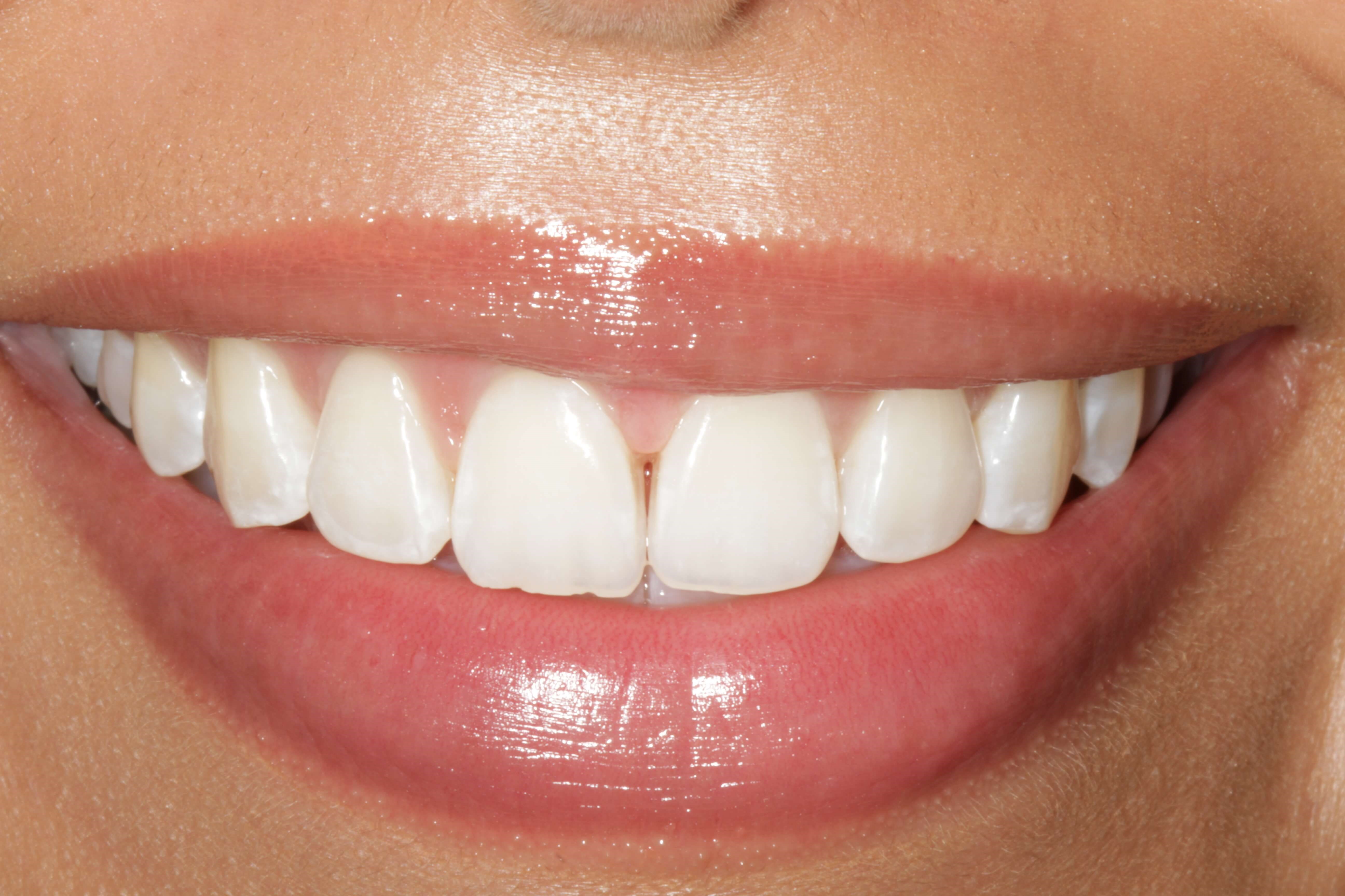 Before and After Photos After