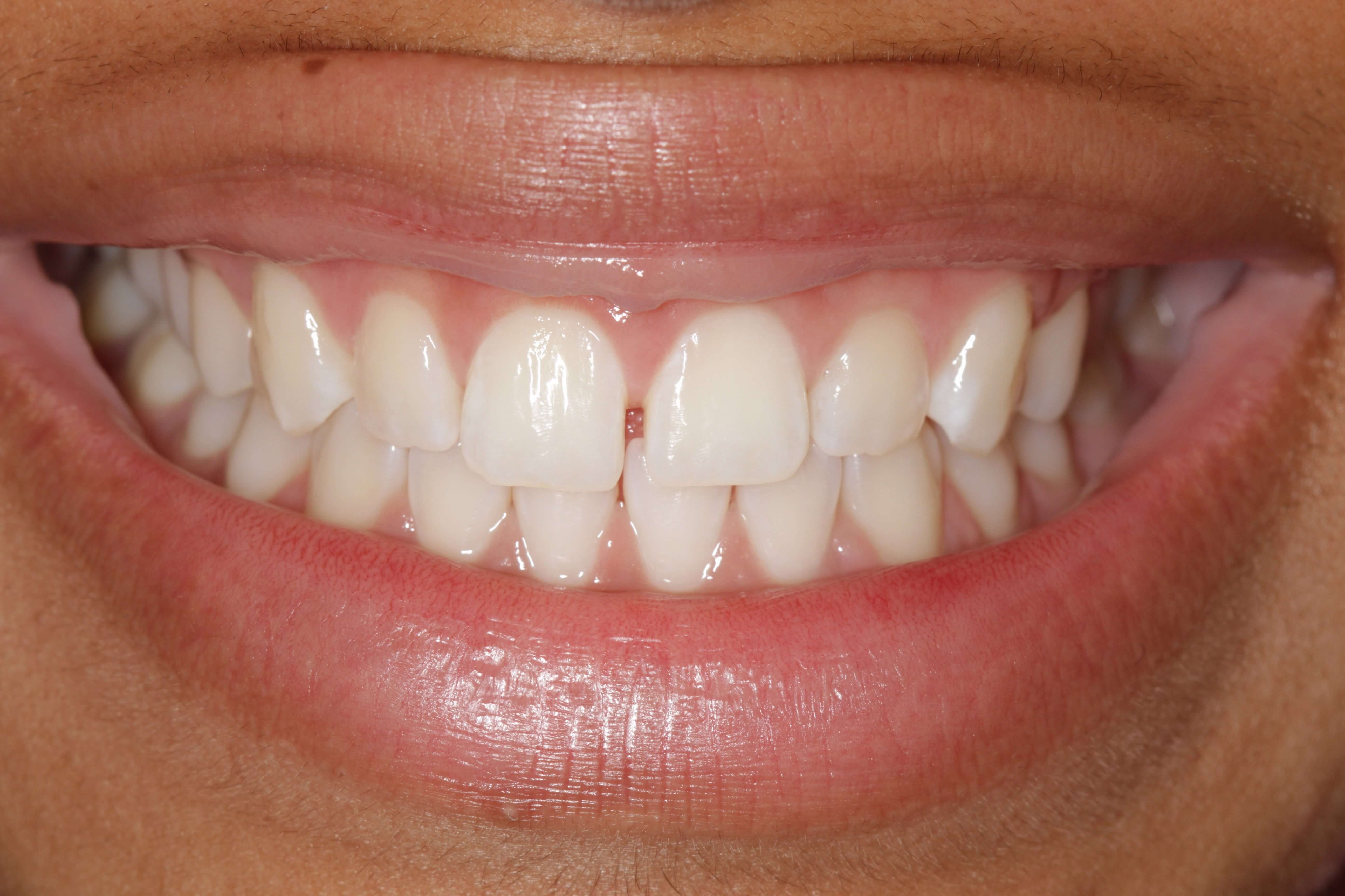 Before and After Smile Before