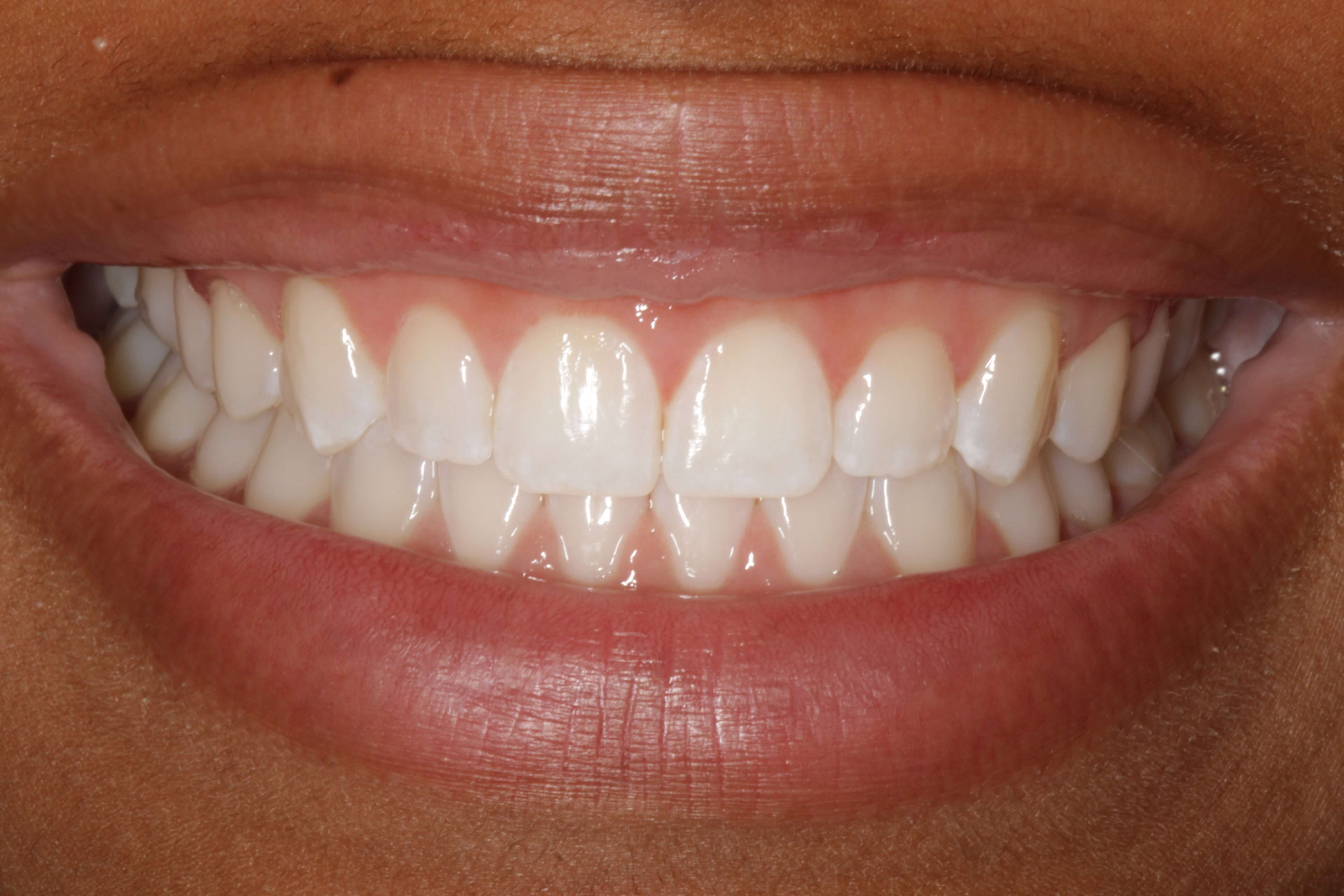 Before and After Smile After