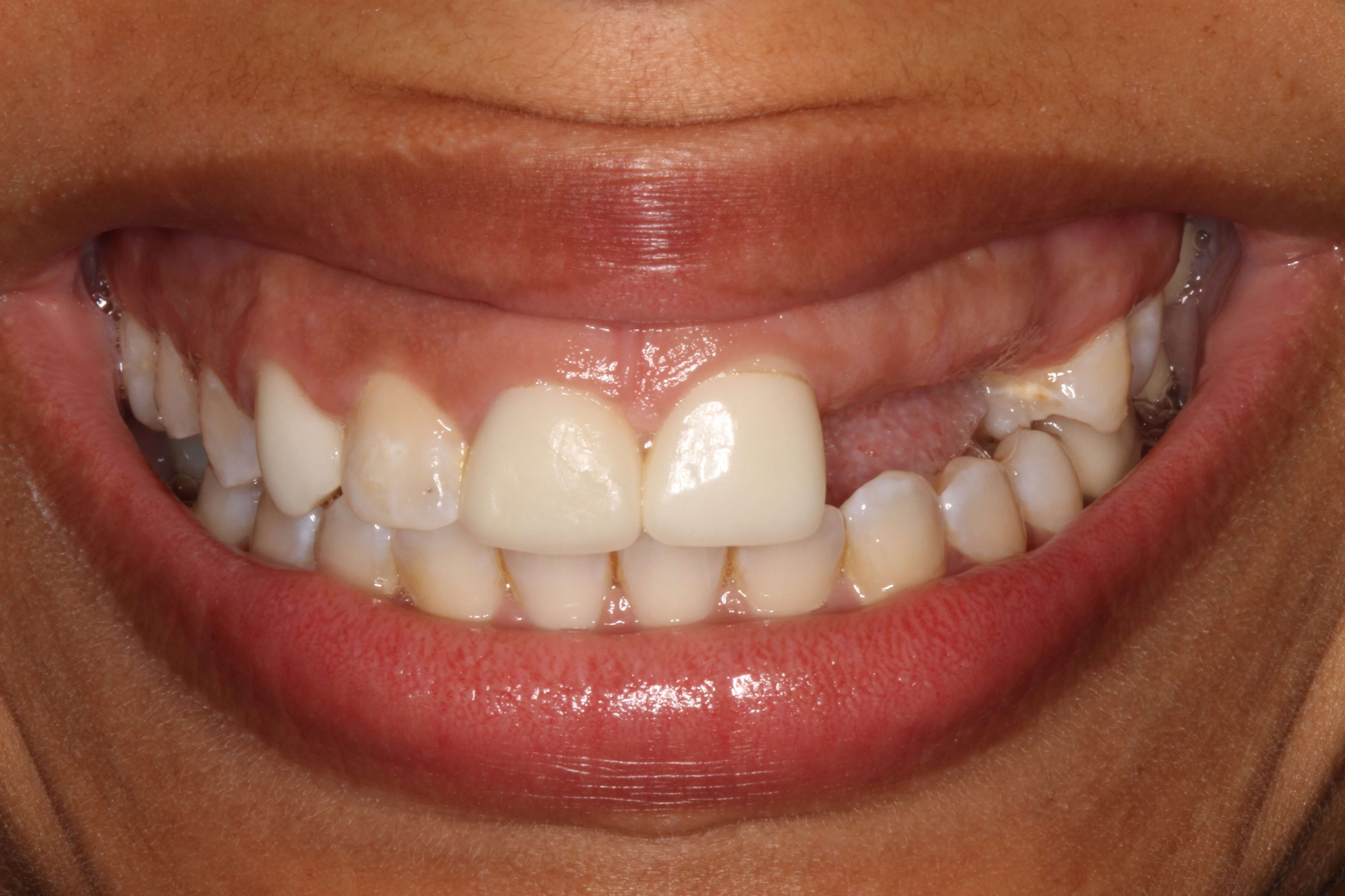 Smile Makeover Before