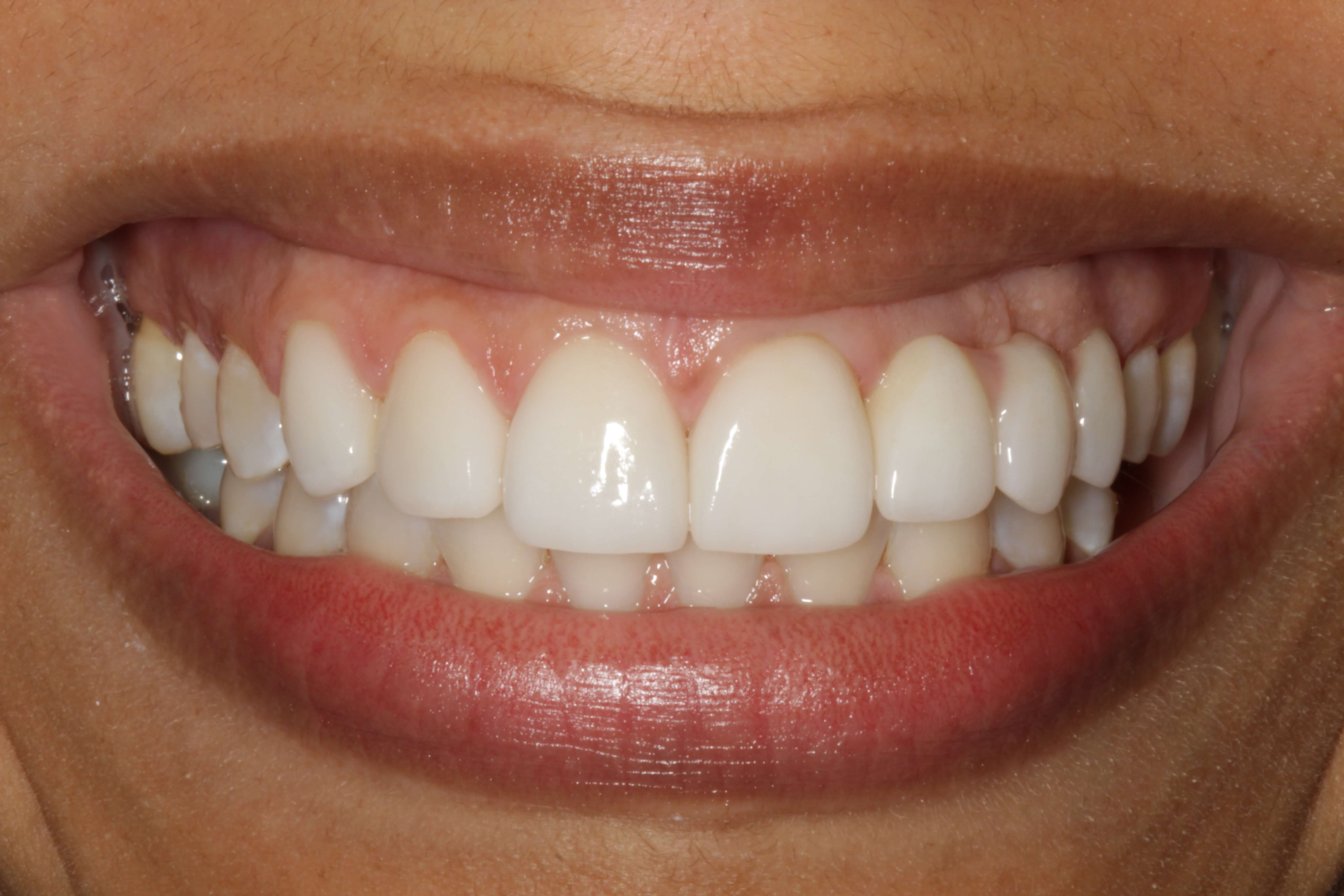 Smile Makeover After