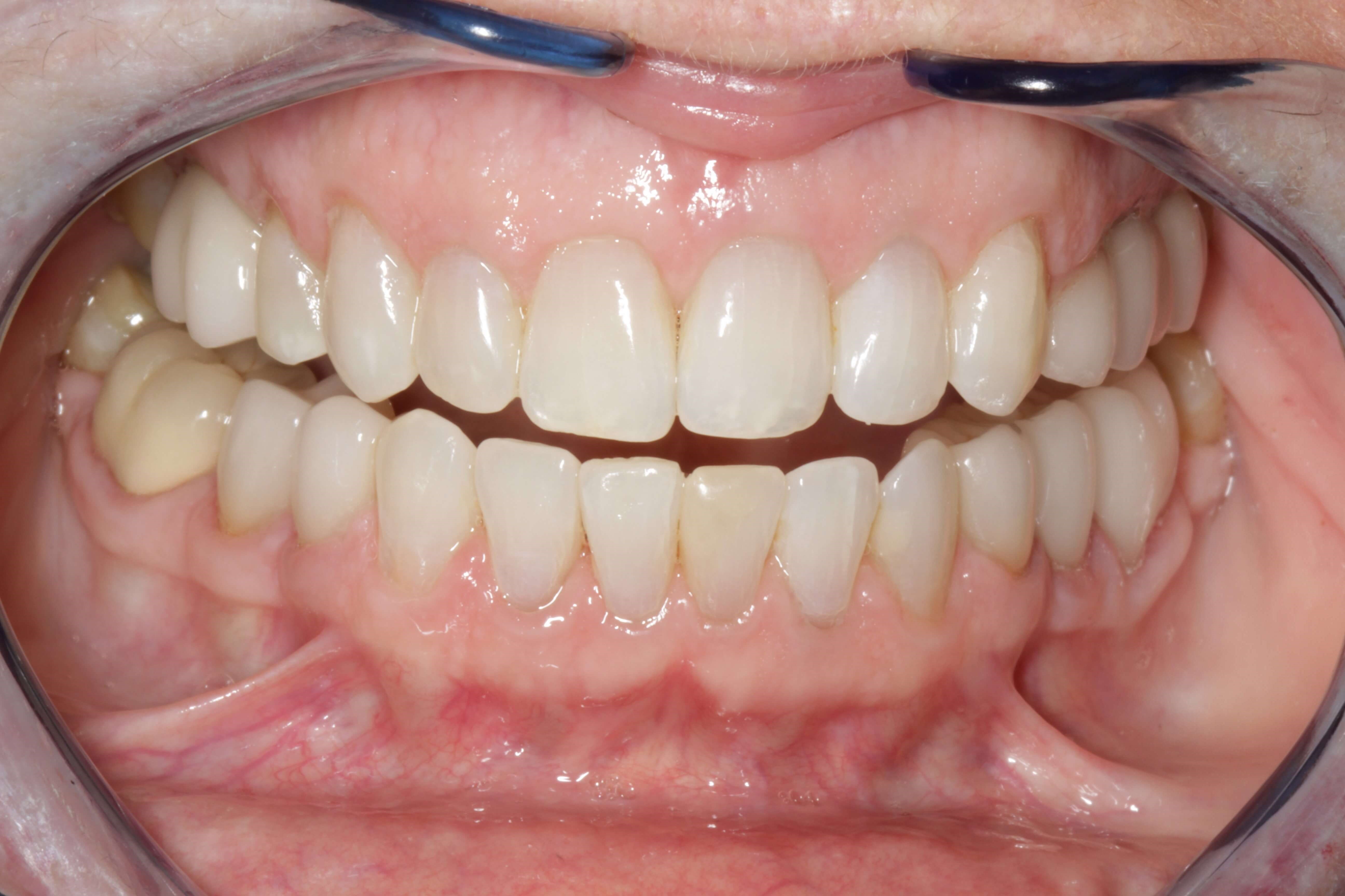 Smile Makeover After