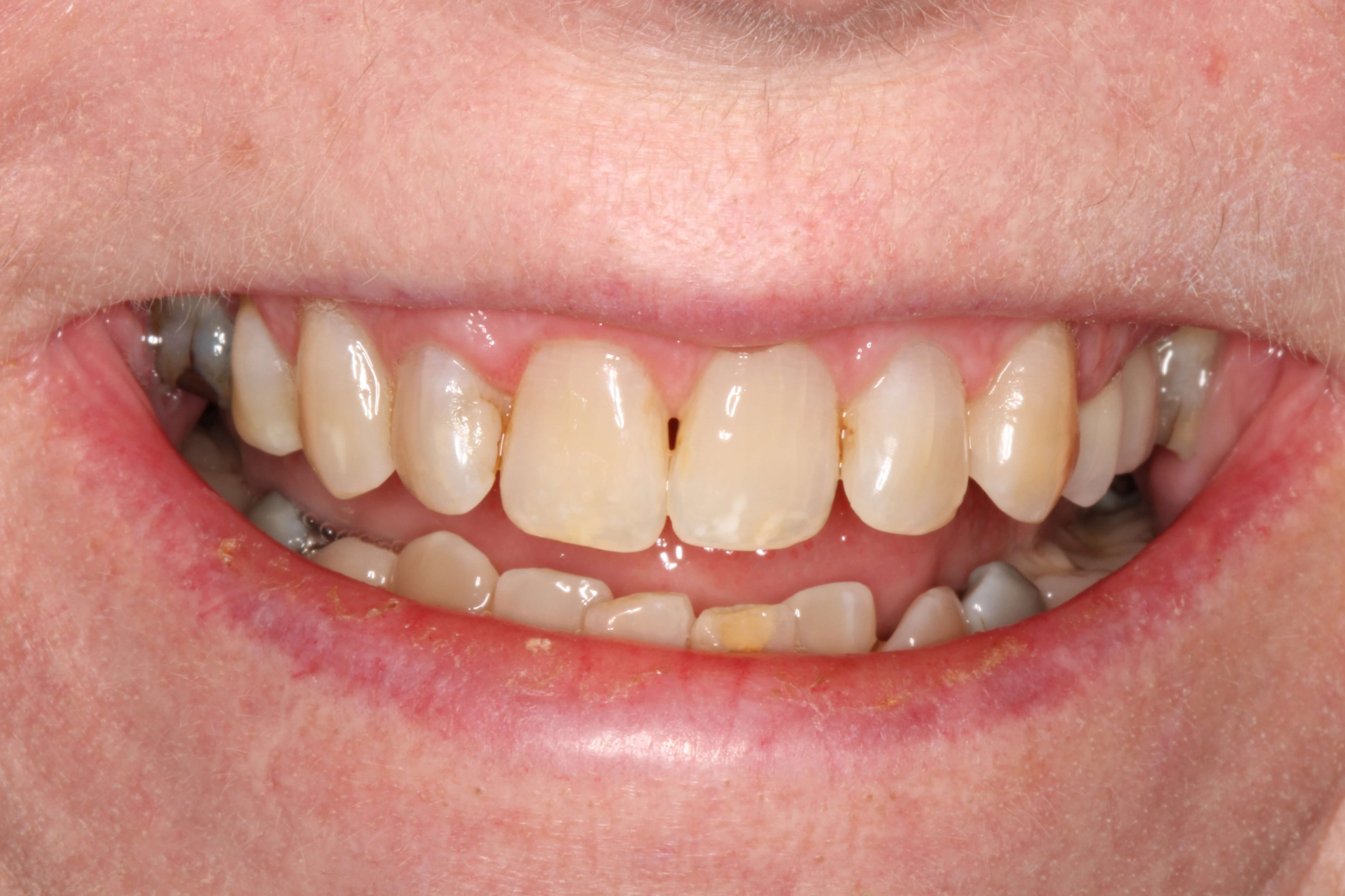 Smile Before and After Before