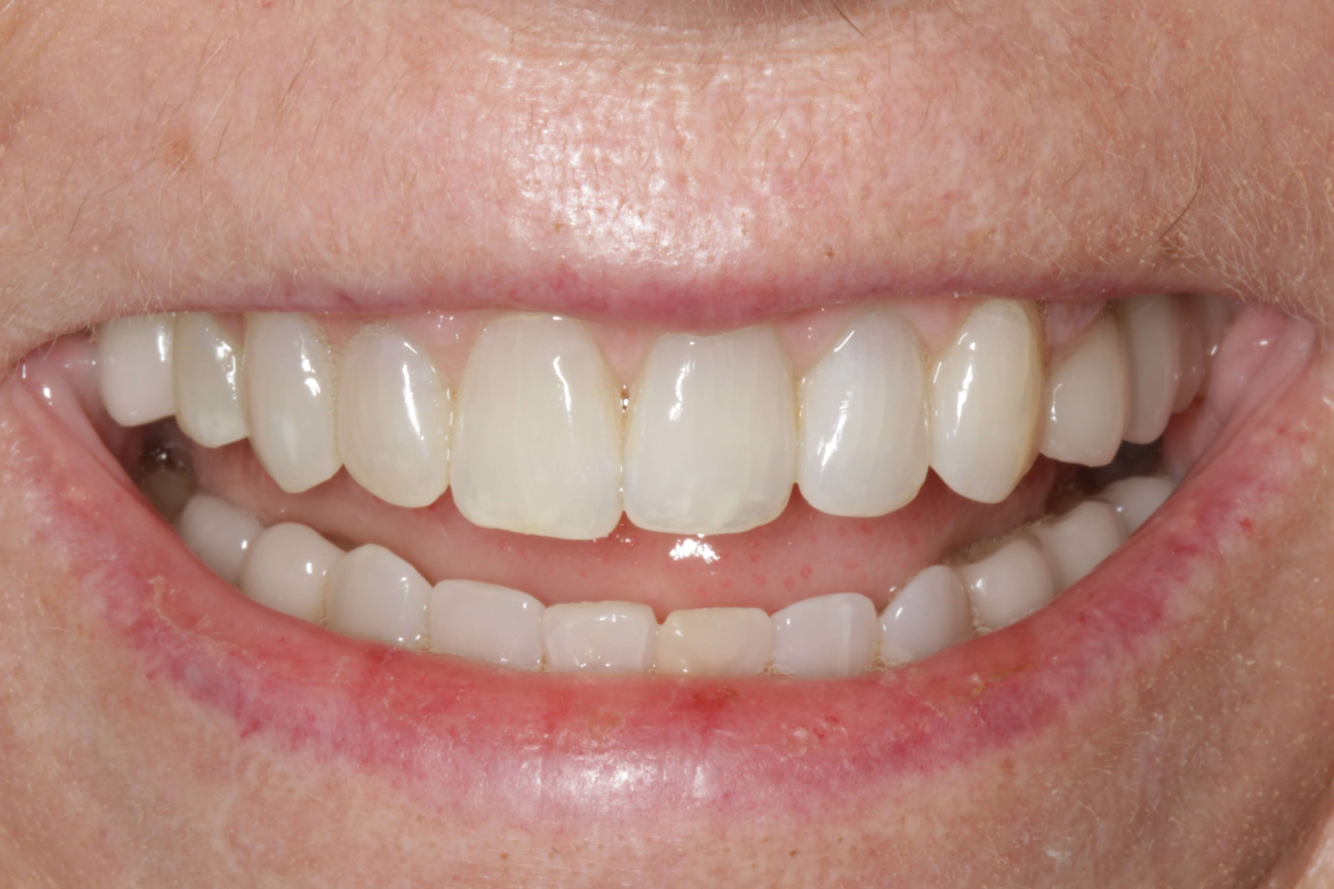 Smile Before and After After