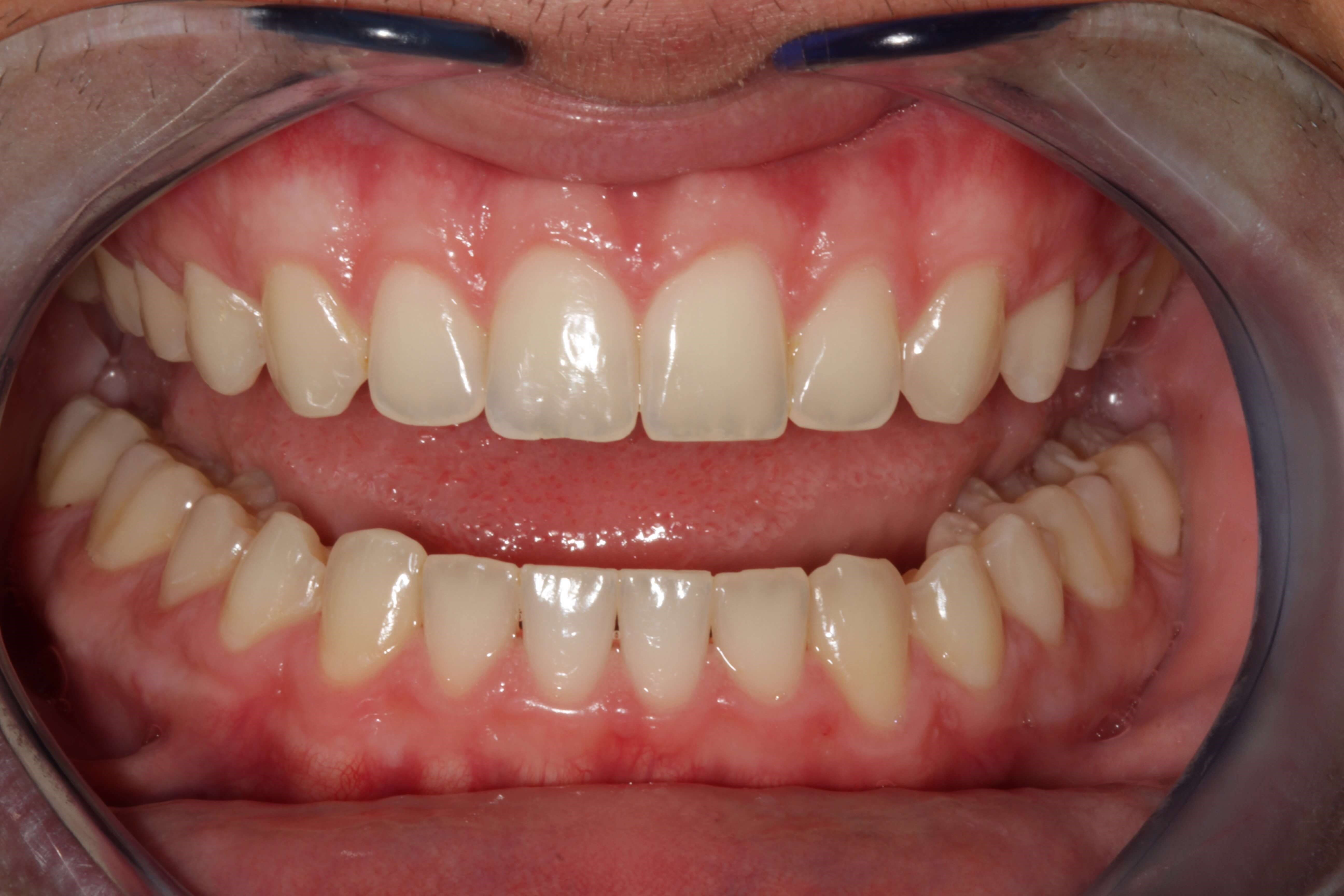 ZOOM!  Whitening Before