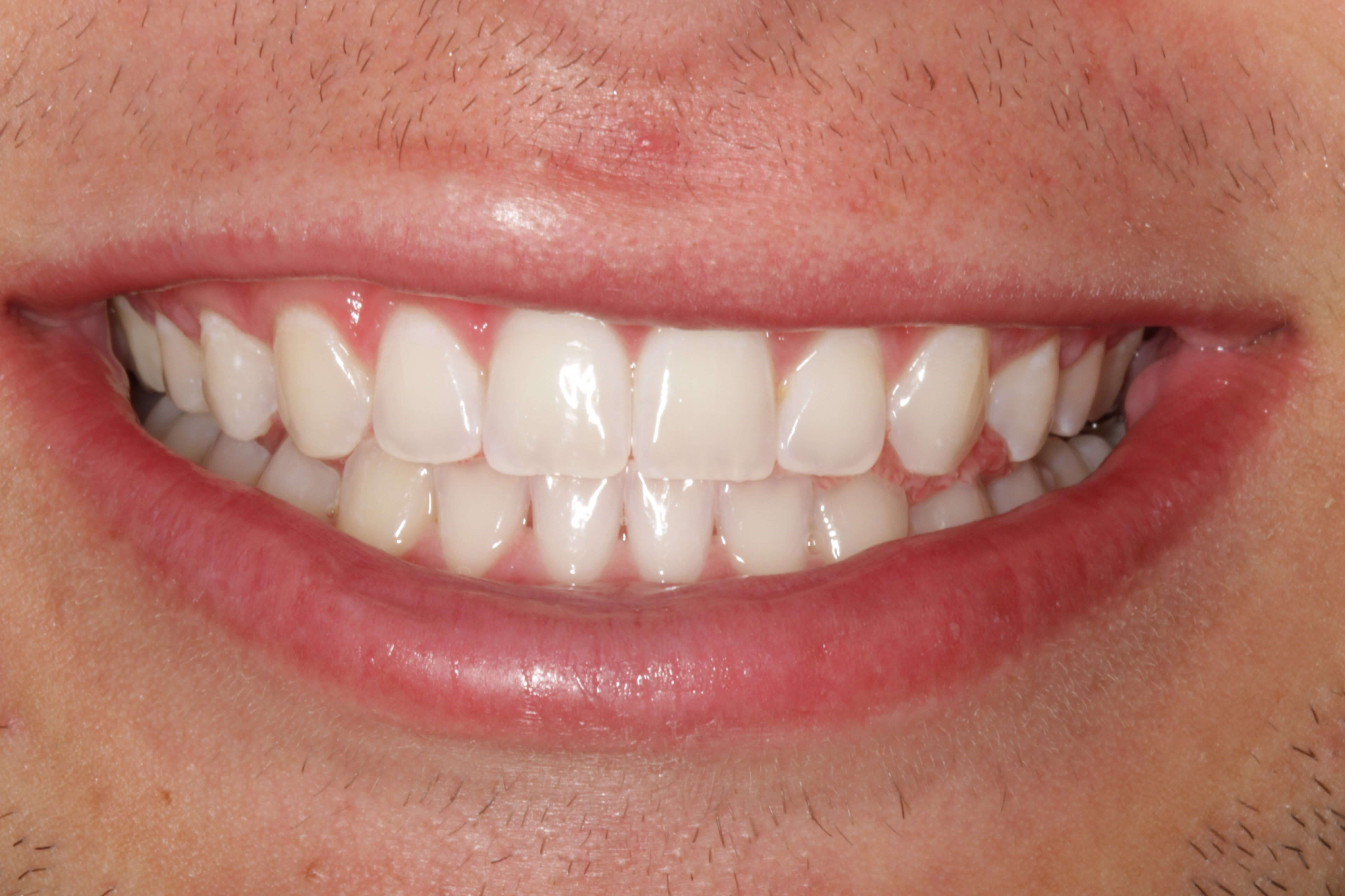 ZOOM!  Whitening After