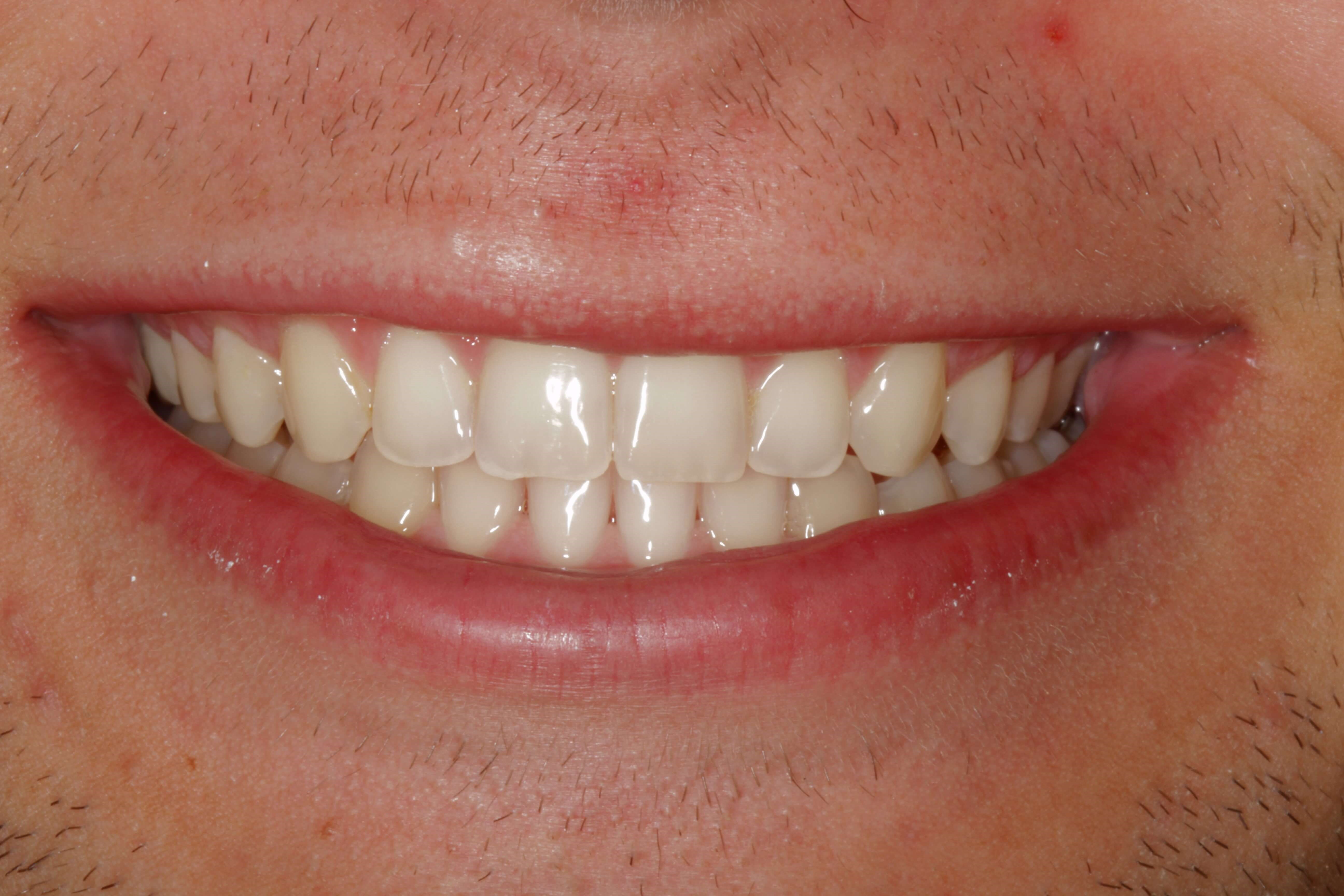 ZOOM!  Whitening Before