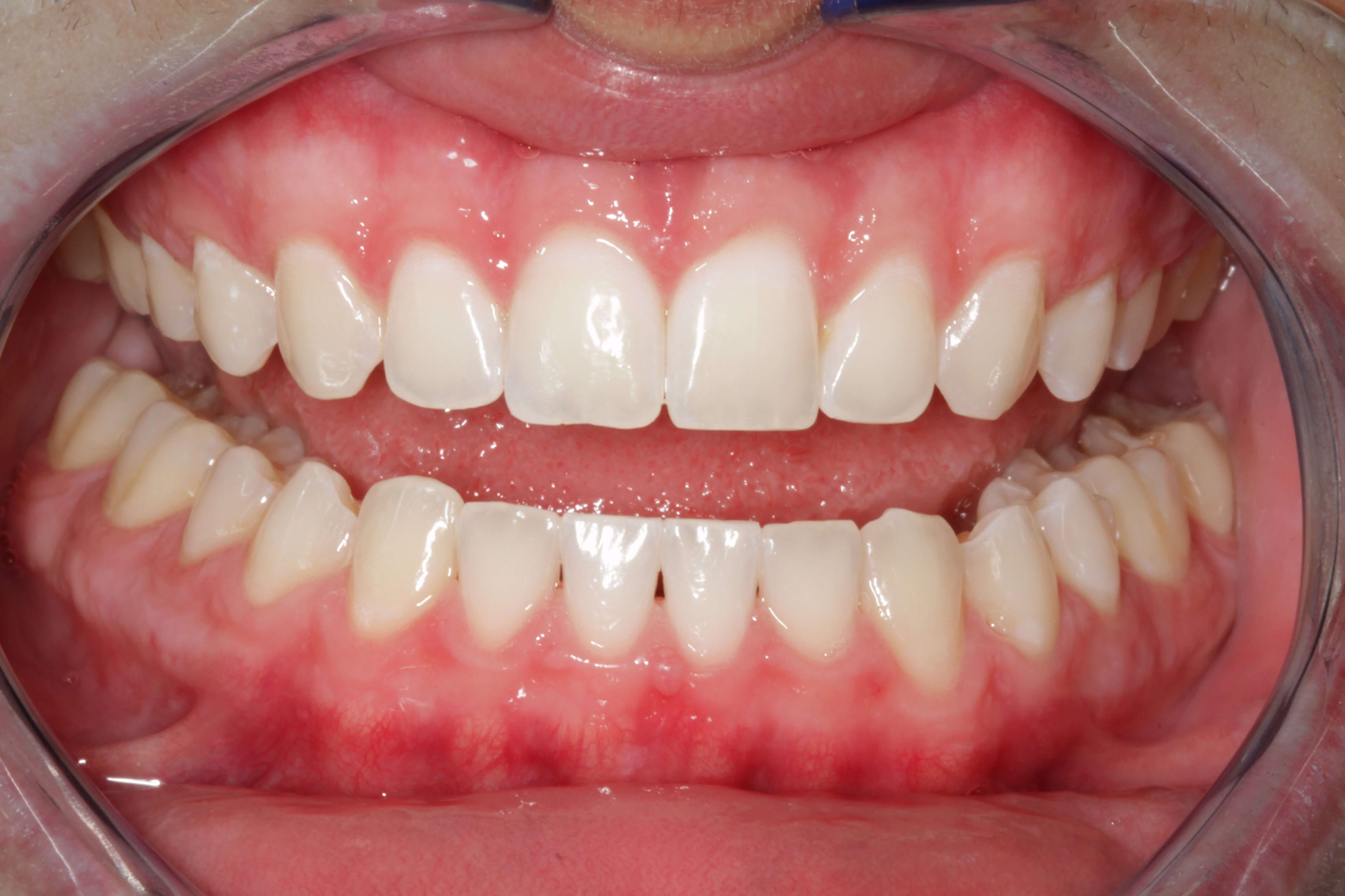 ZOOM!  Whitening After