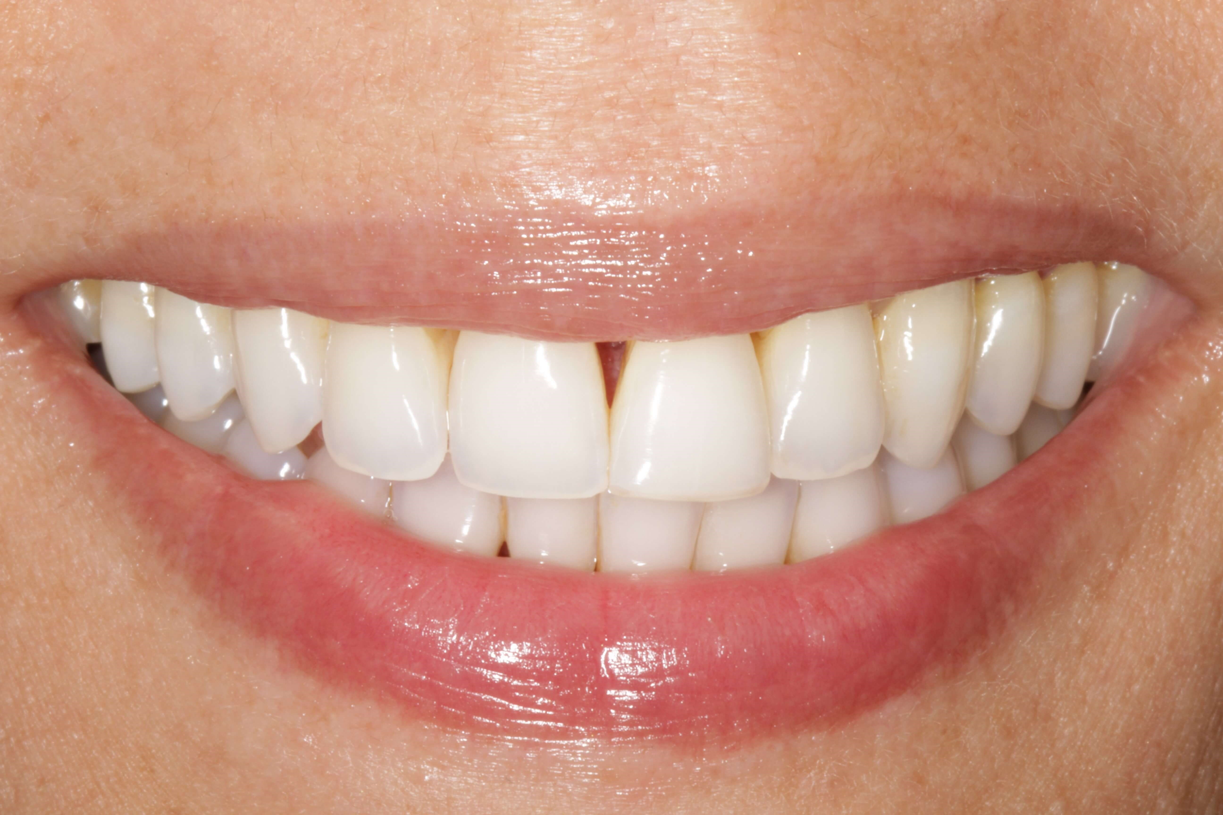 Before and After Photos Before