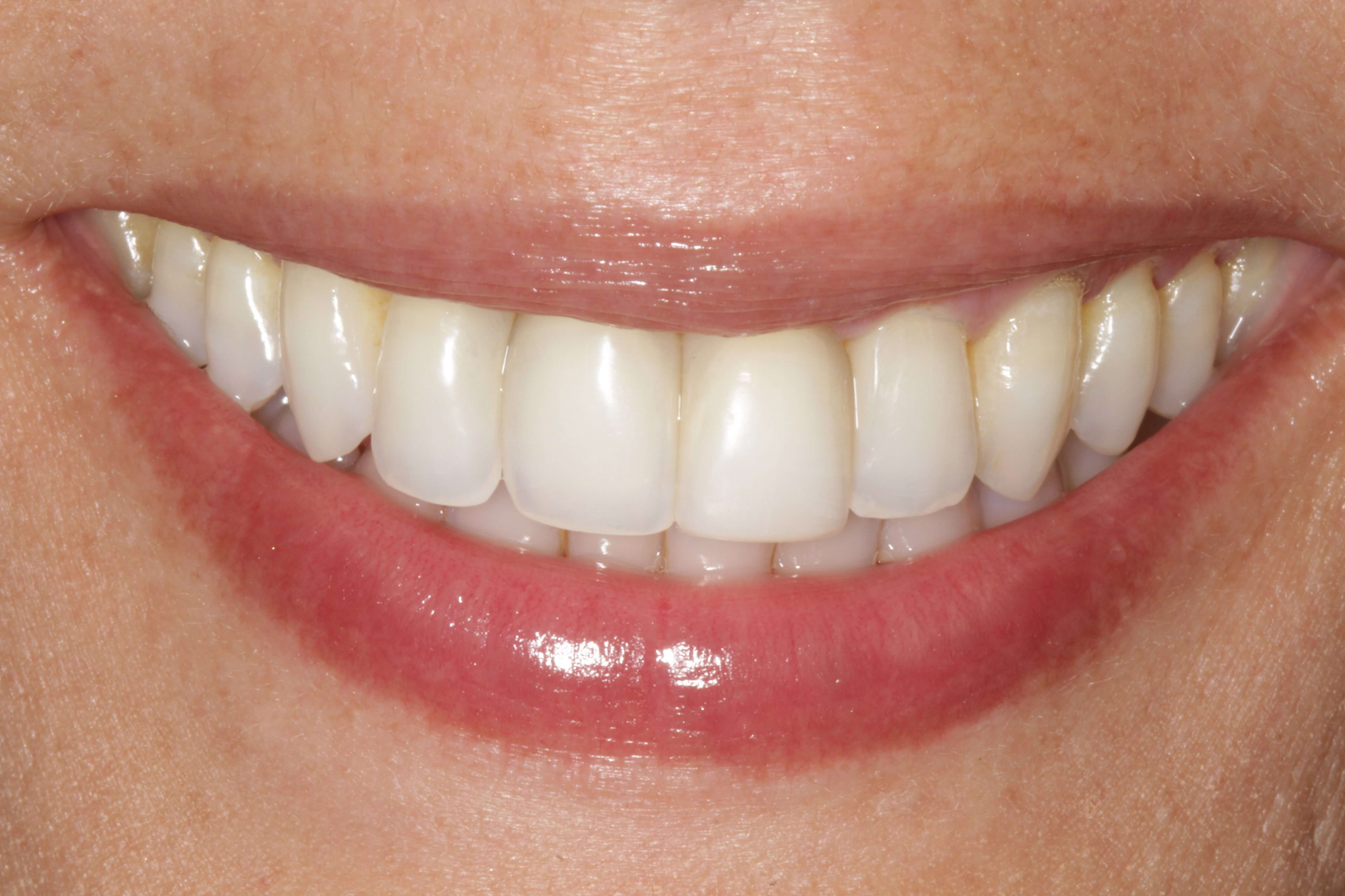 Before and After Photos After