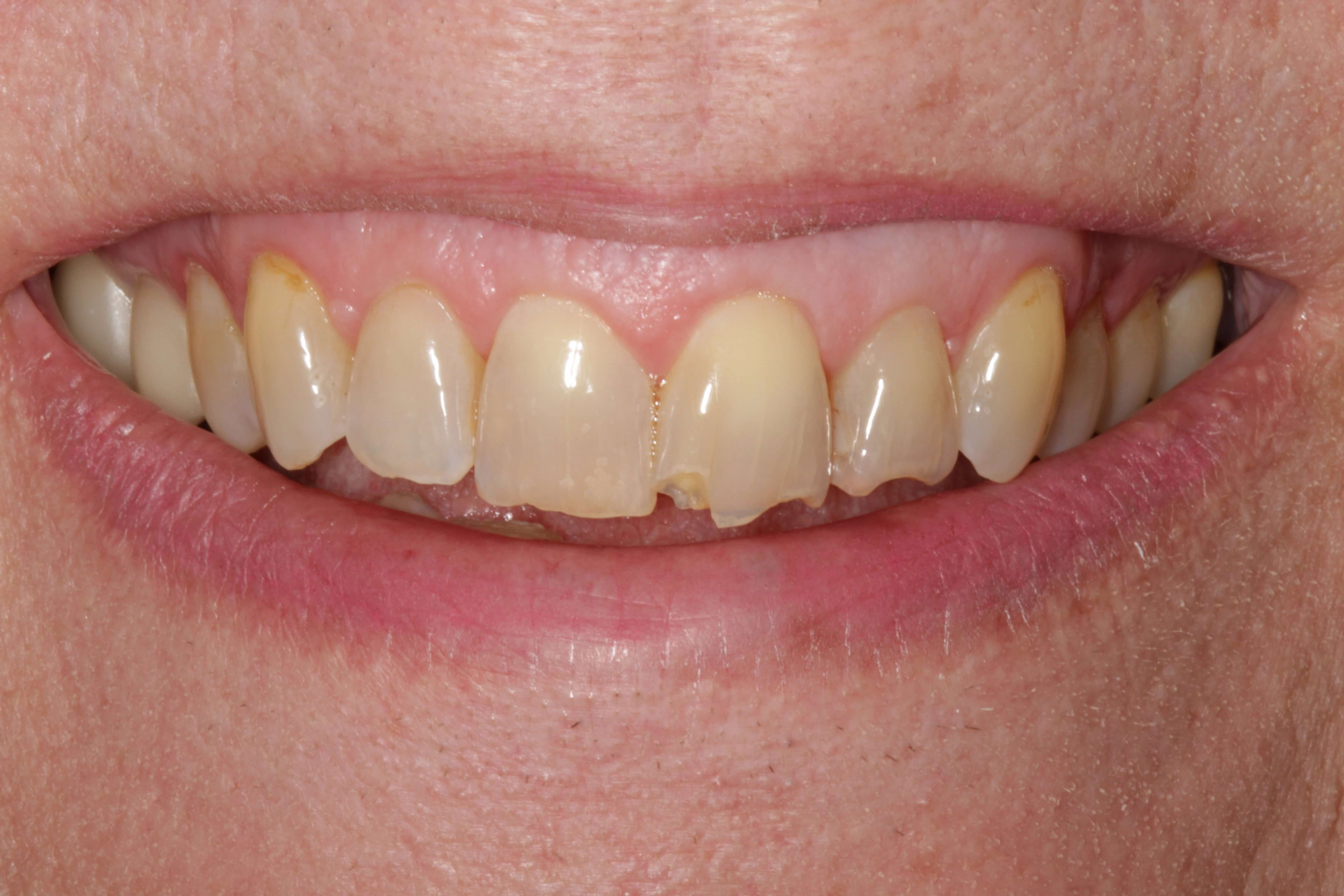 Smile Makeover Before