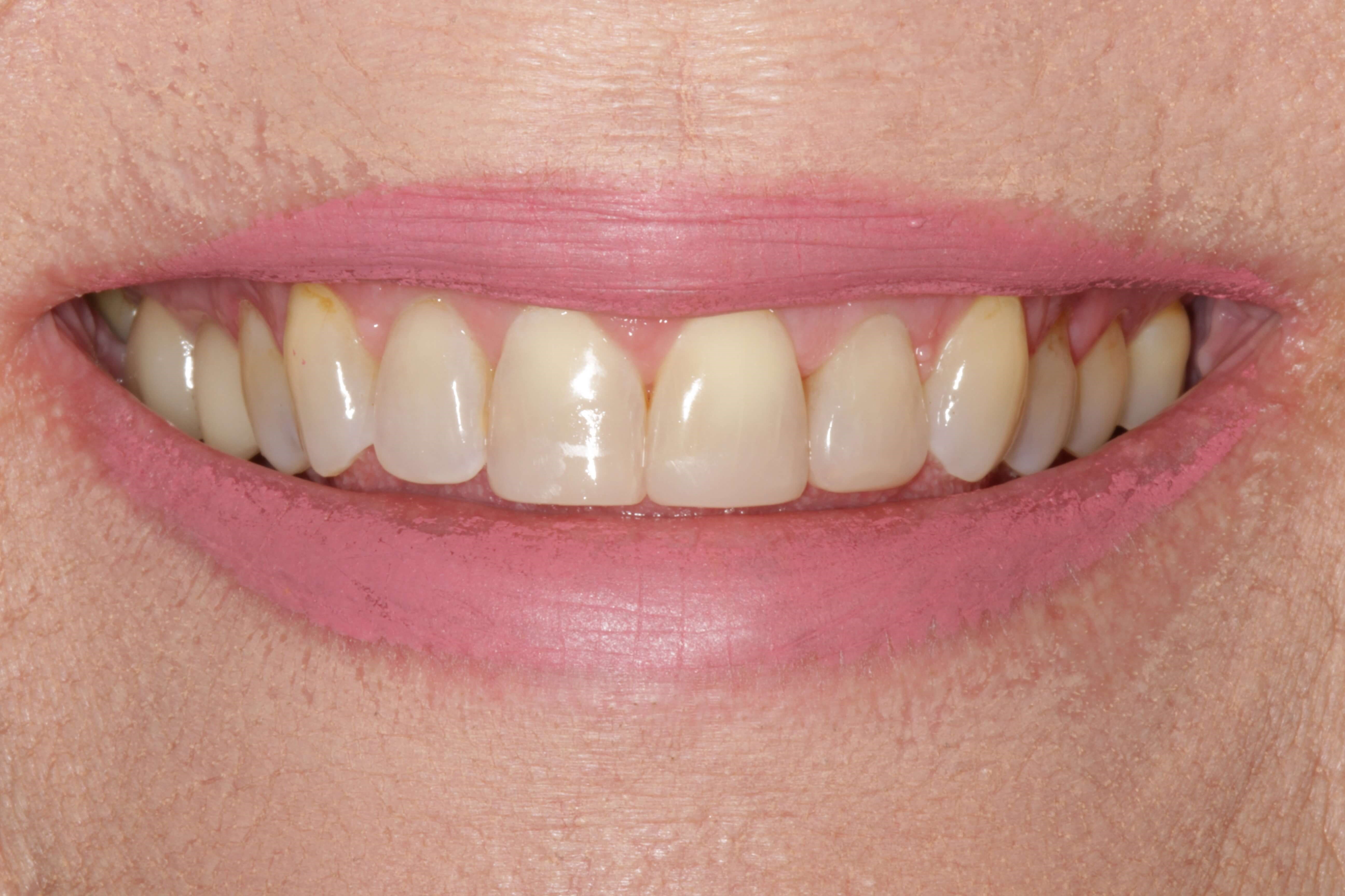 Smile Makeover After