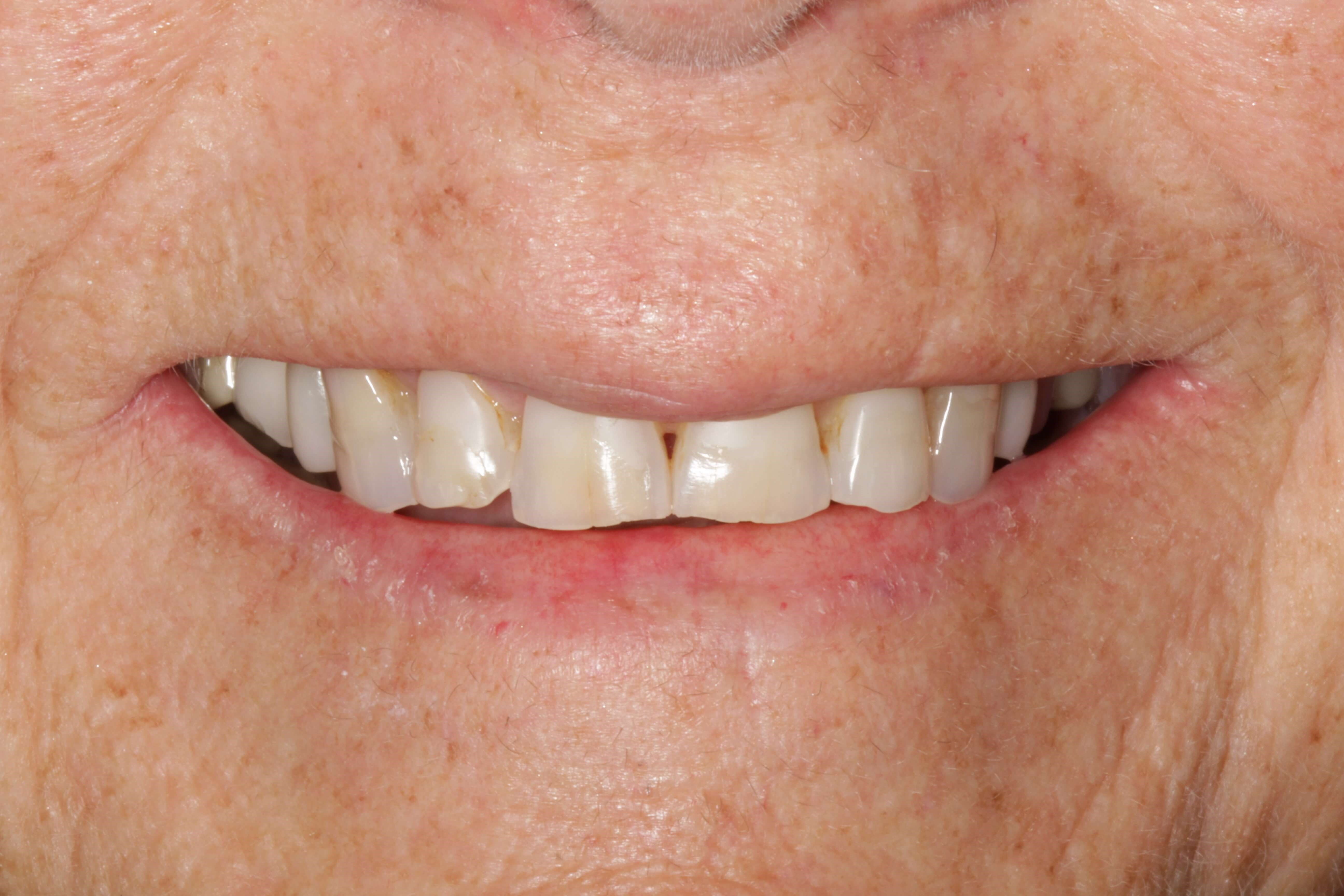 Smile Makeover Before