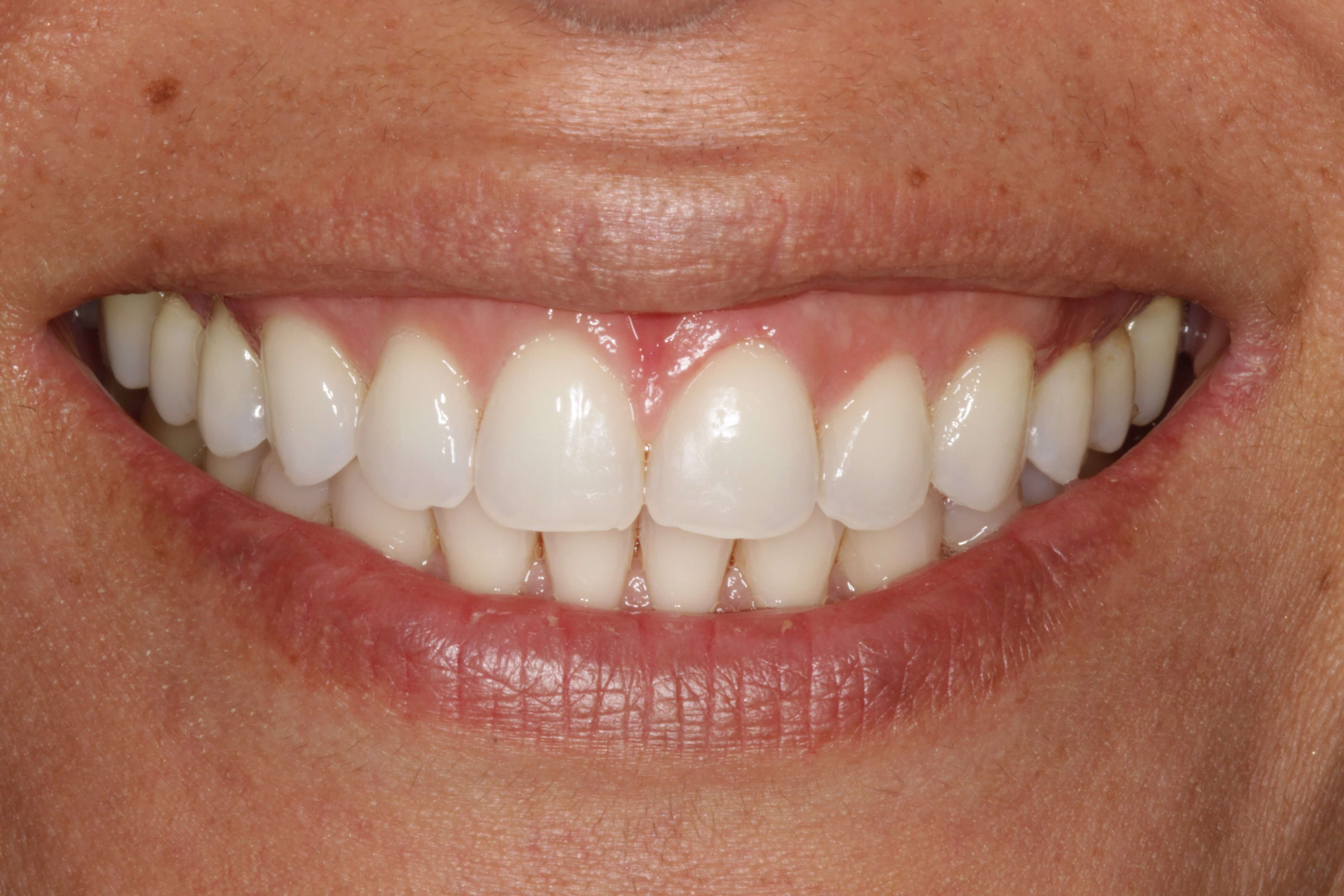 Before and After Photos Before