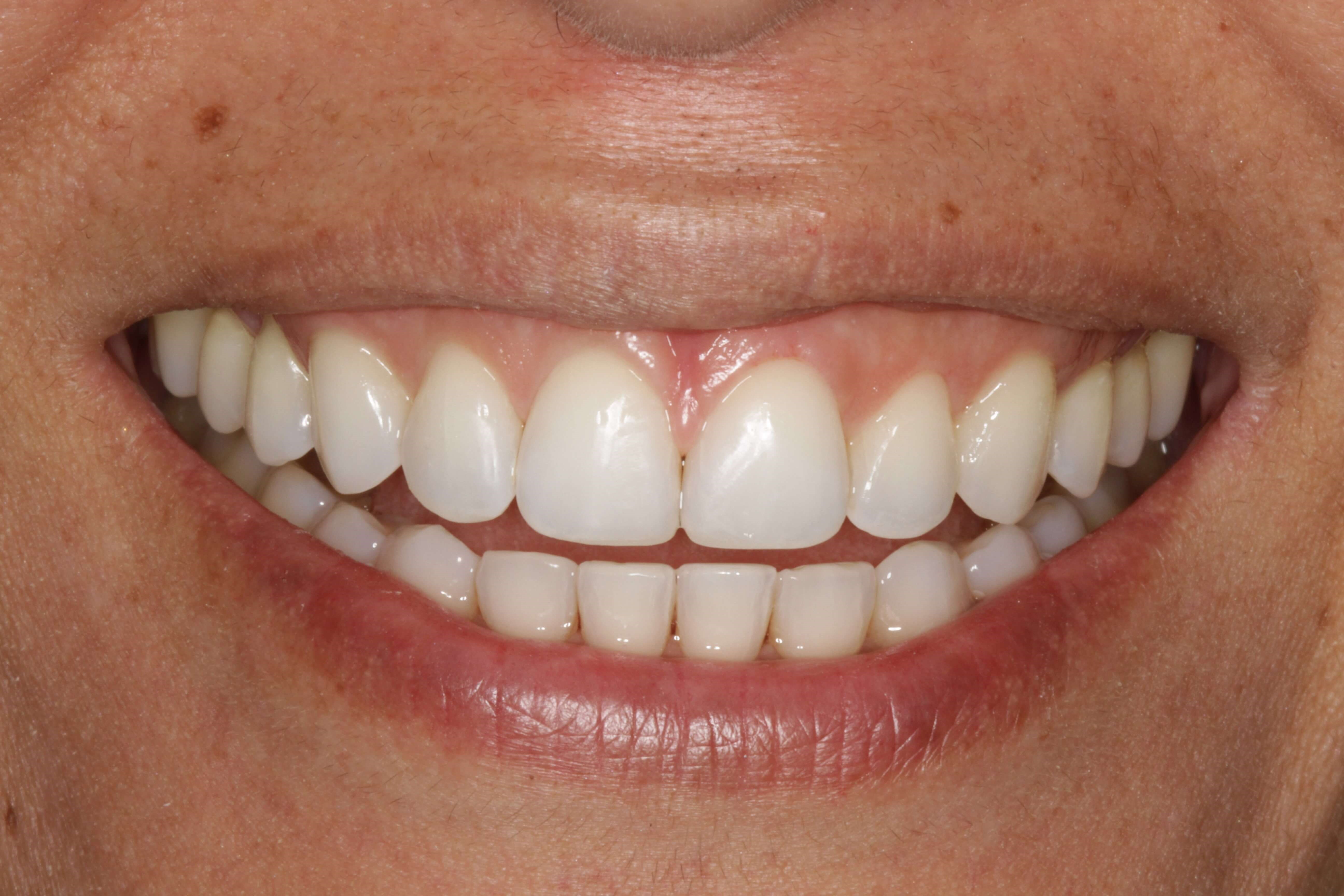 Before and After Photos After