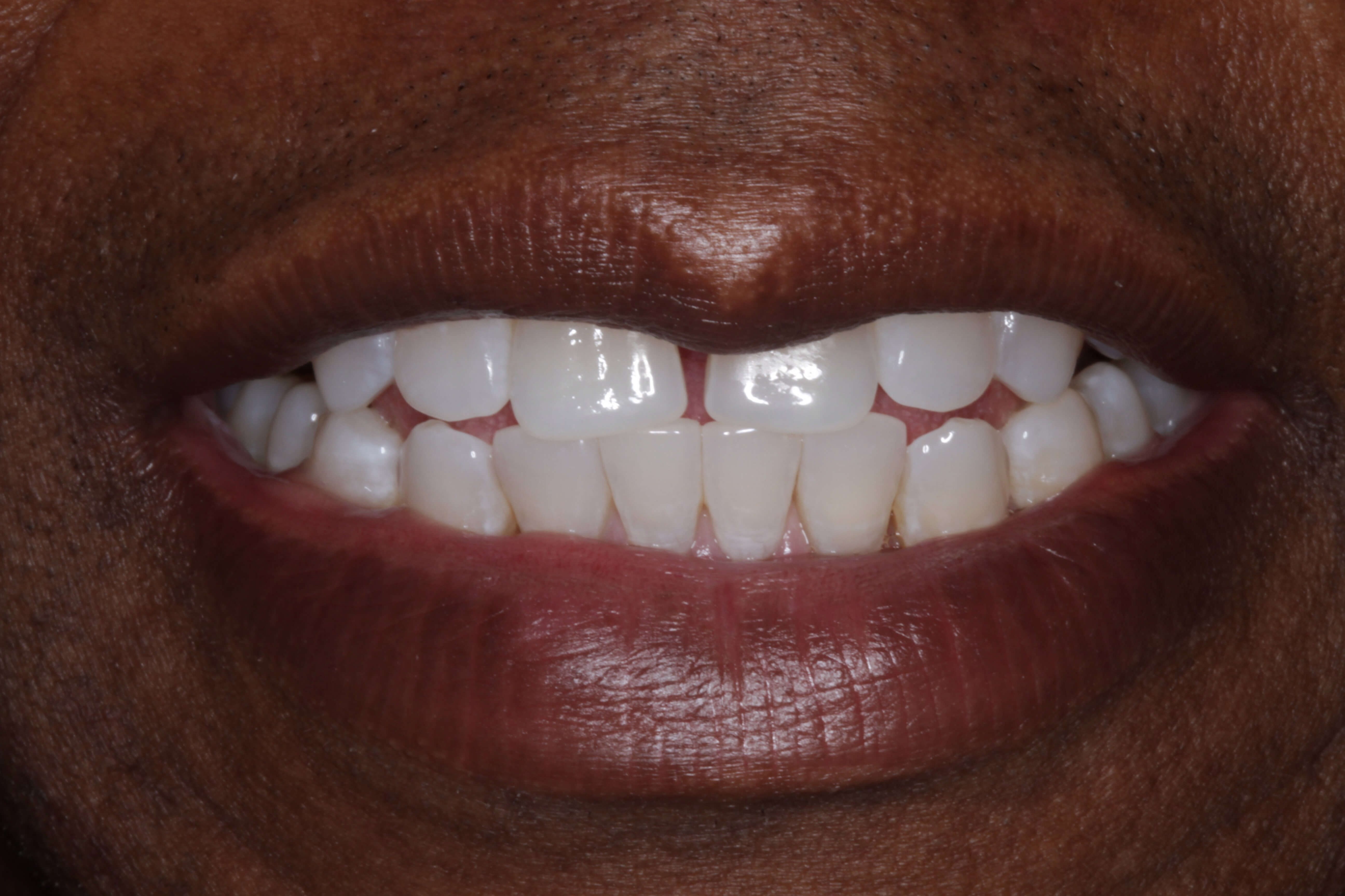 Smile Makeover Before