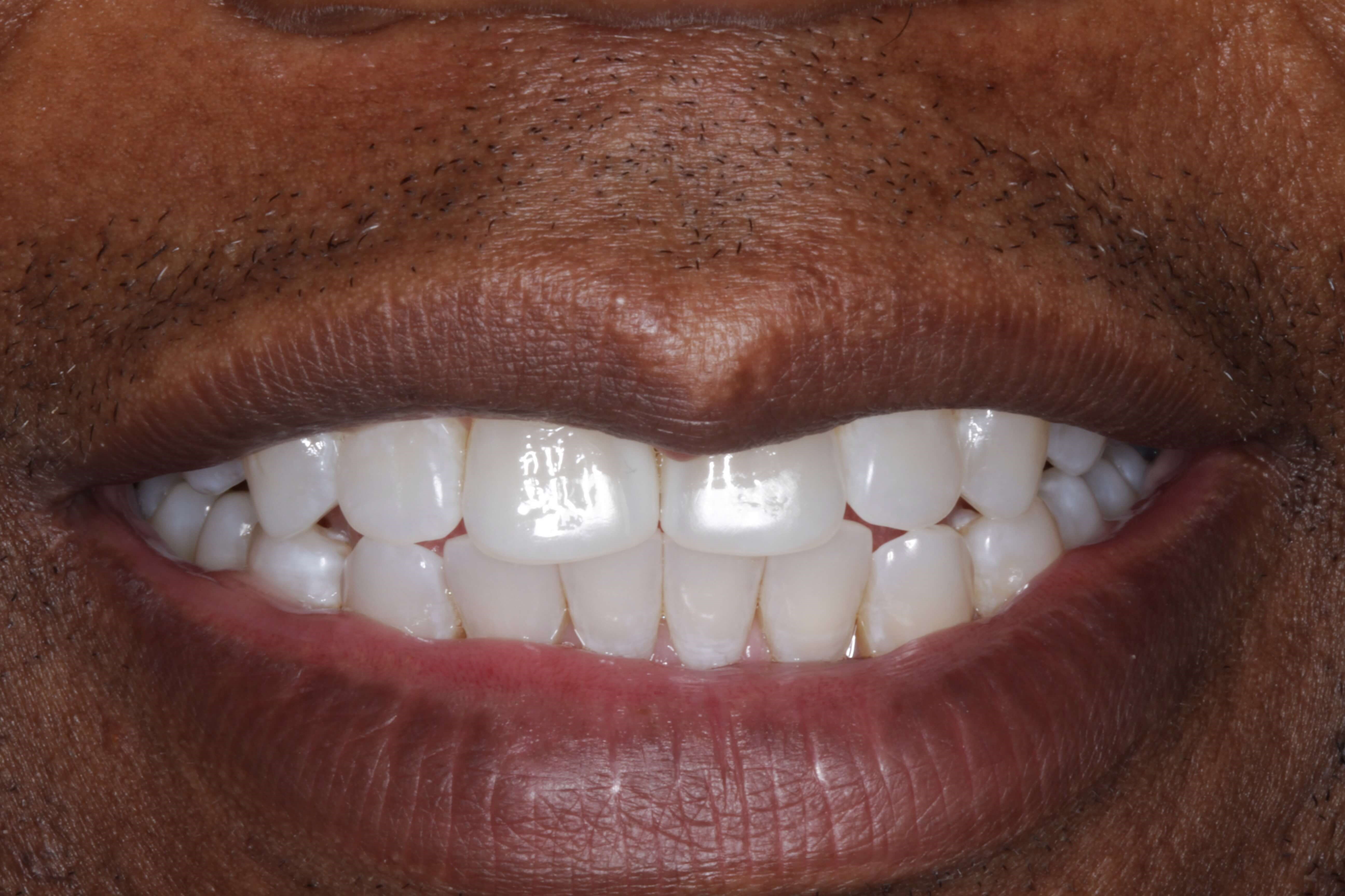 Smile Makeover After