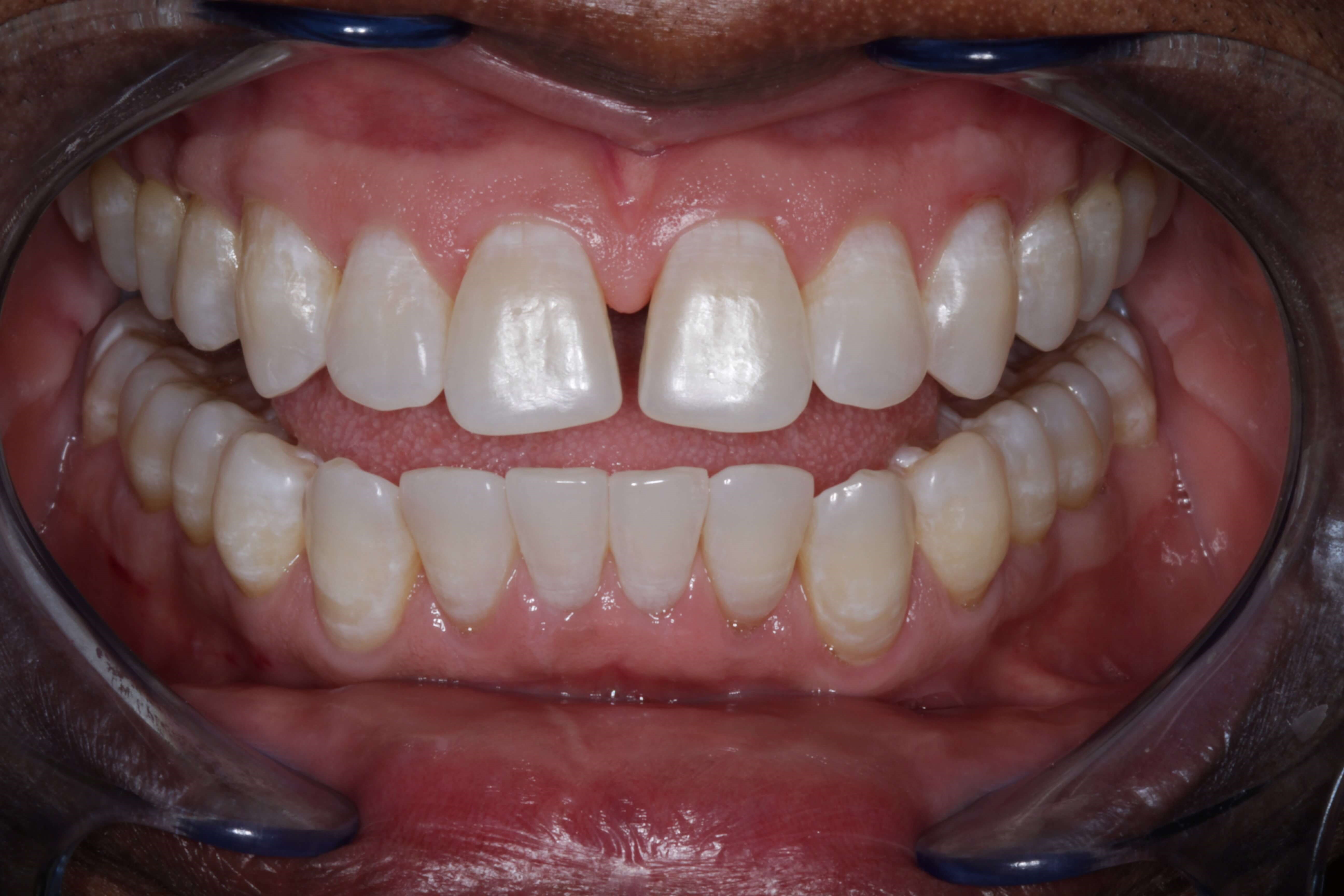 Before and After Photos Before