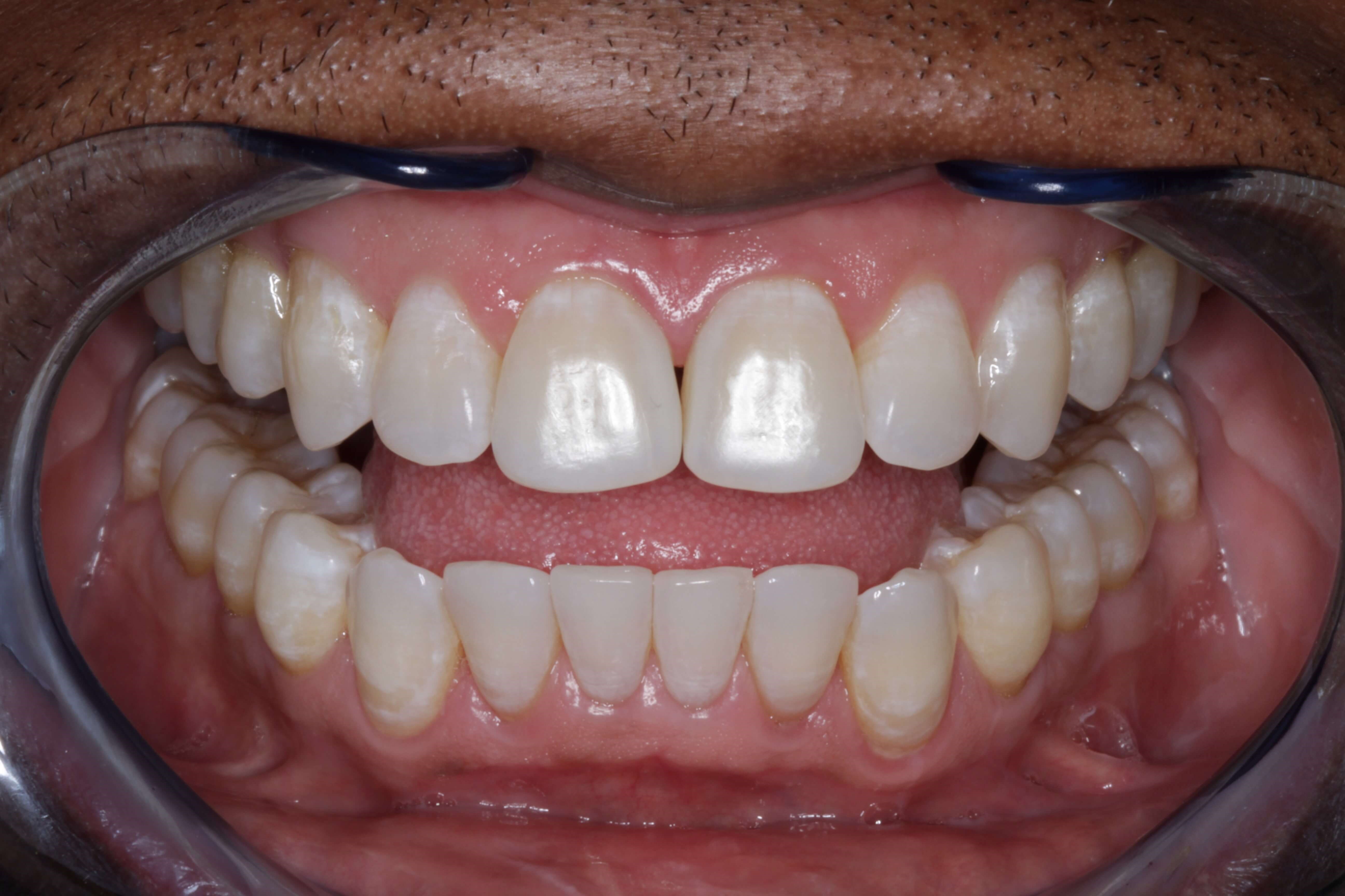 Before and After Photos After