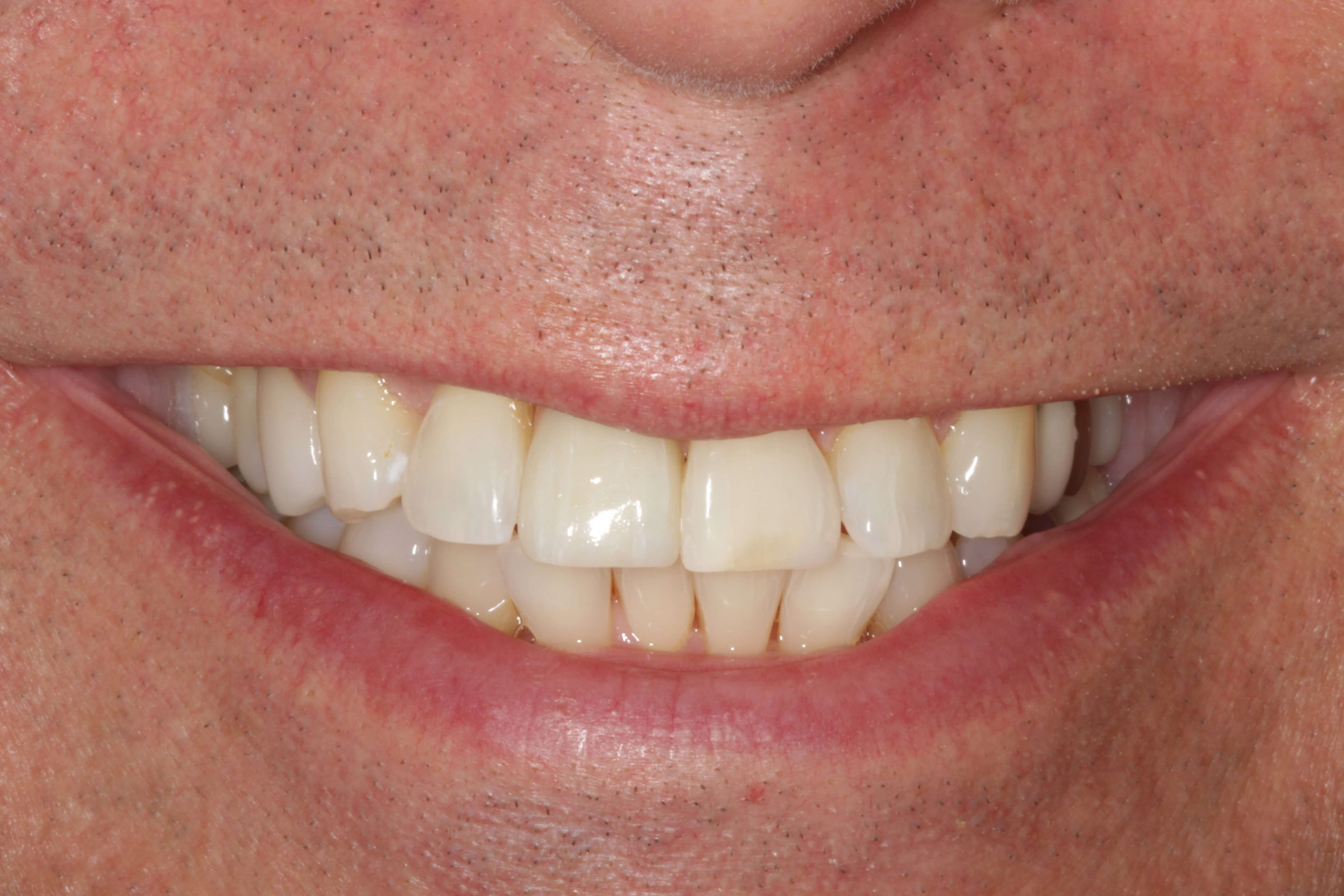 Before and After Photos After