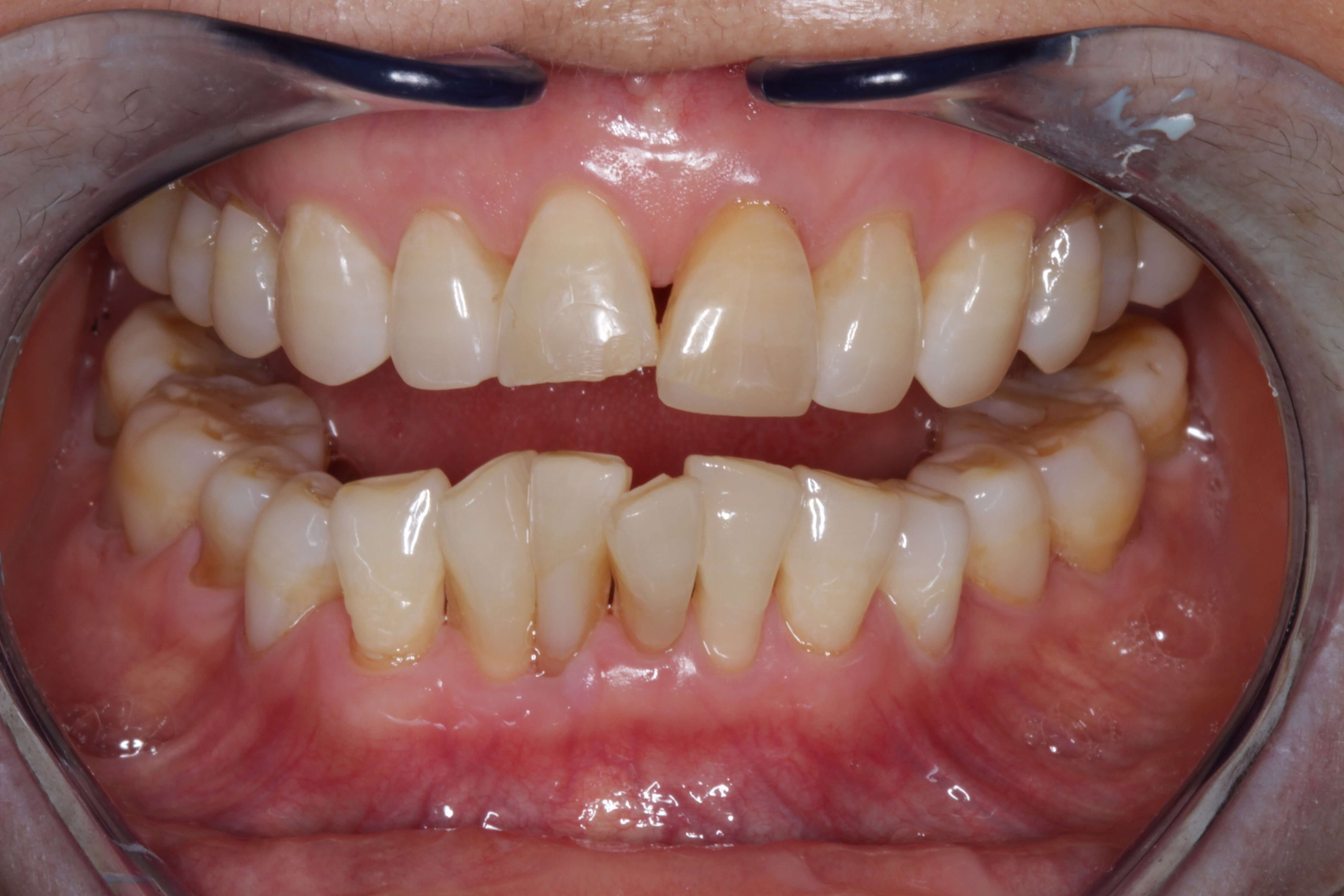 Smile Makeover Before