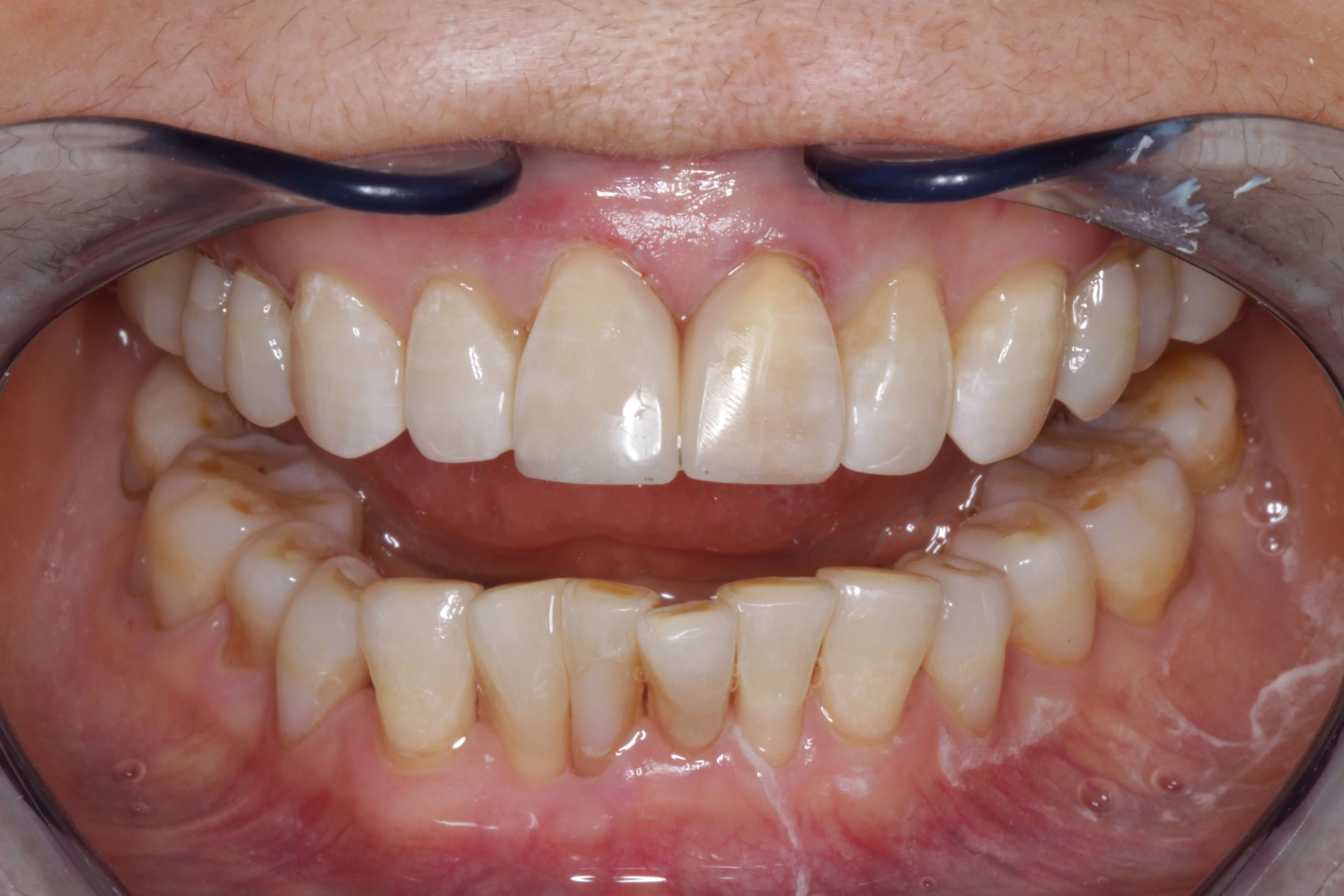 Smile Makeover After