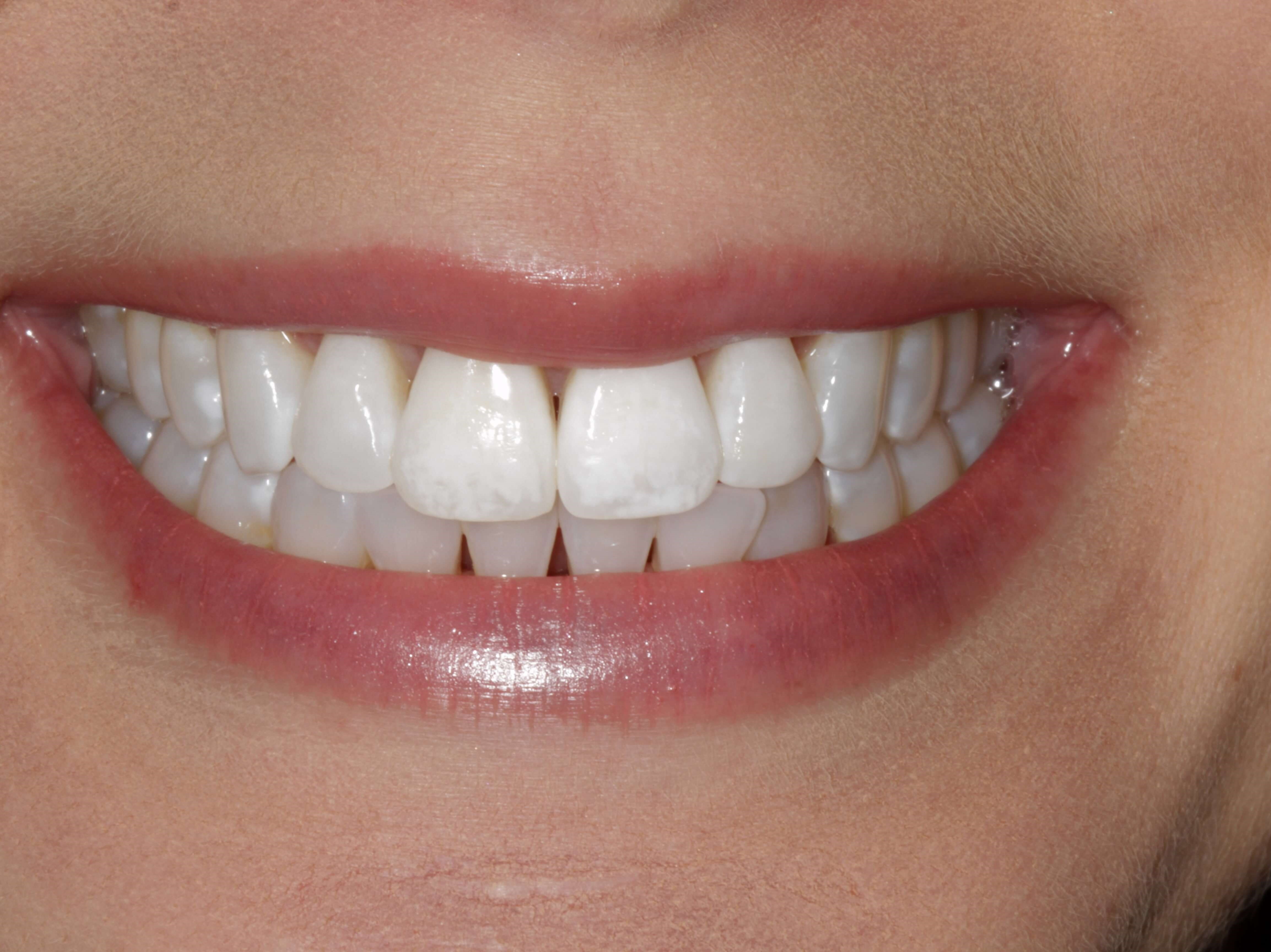 Before and After Photos Before