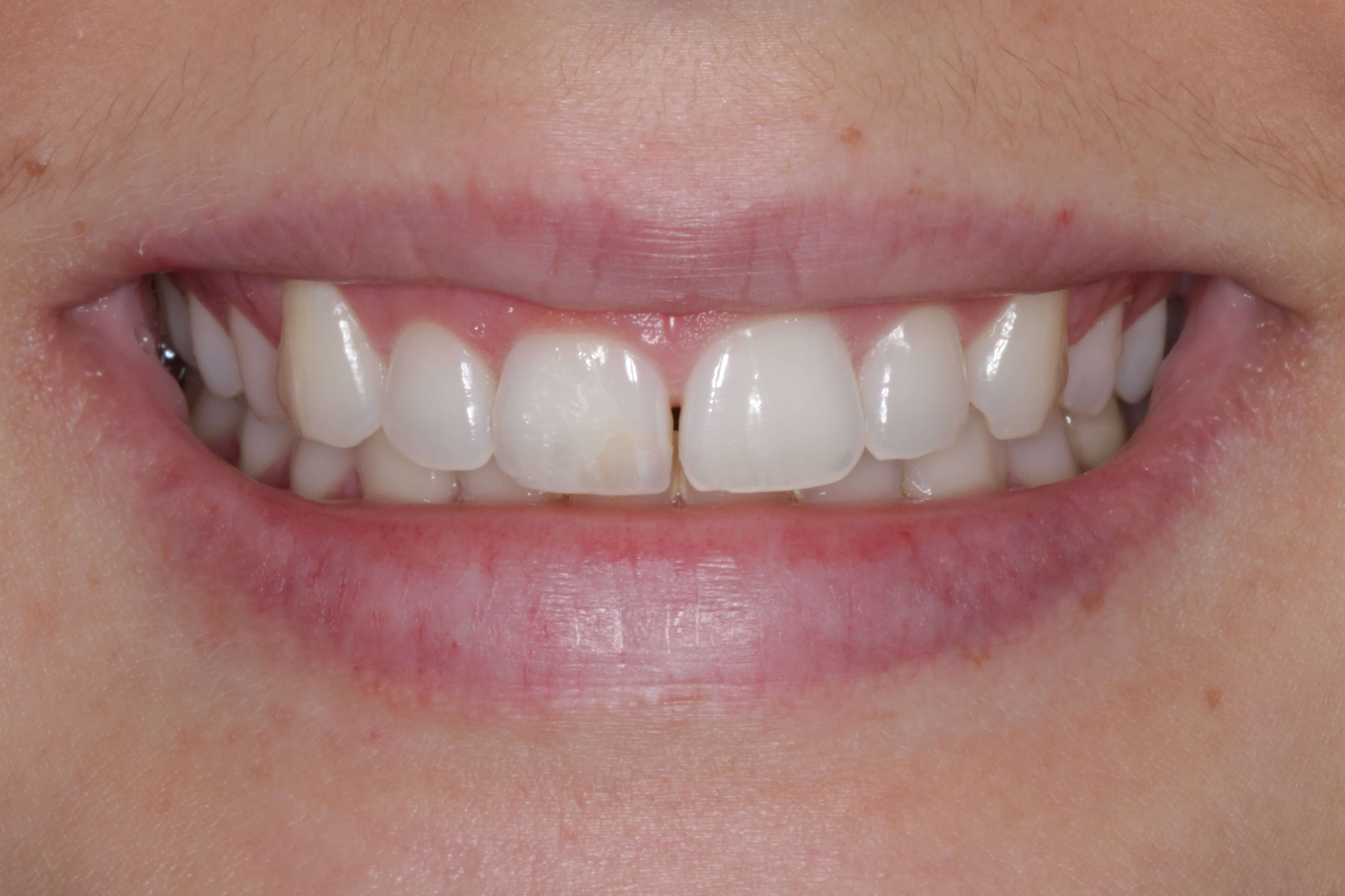 Smile Makeover Before