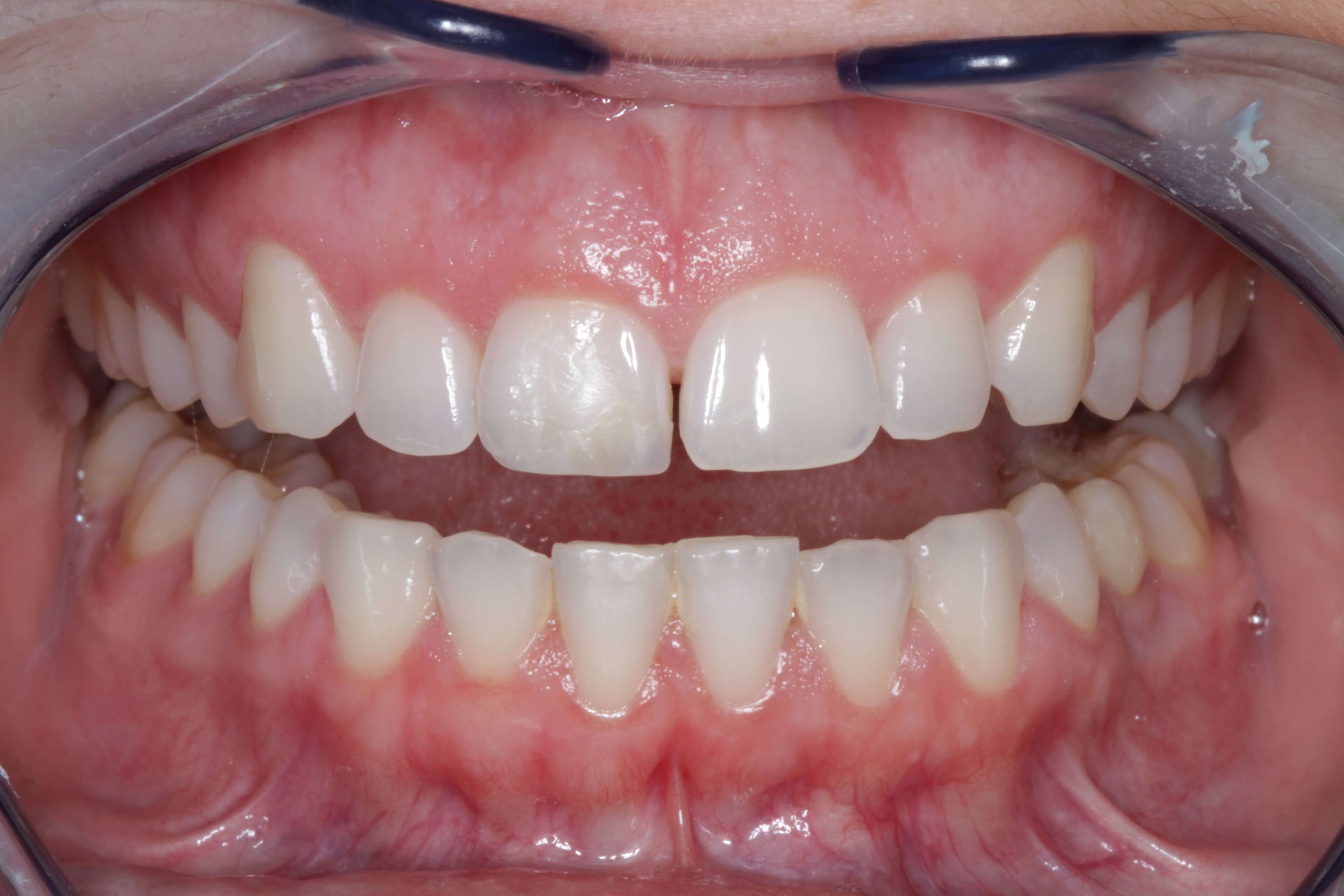 Before and After Photos Before