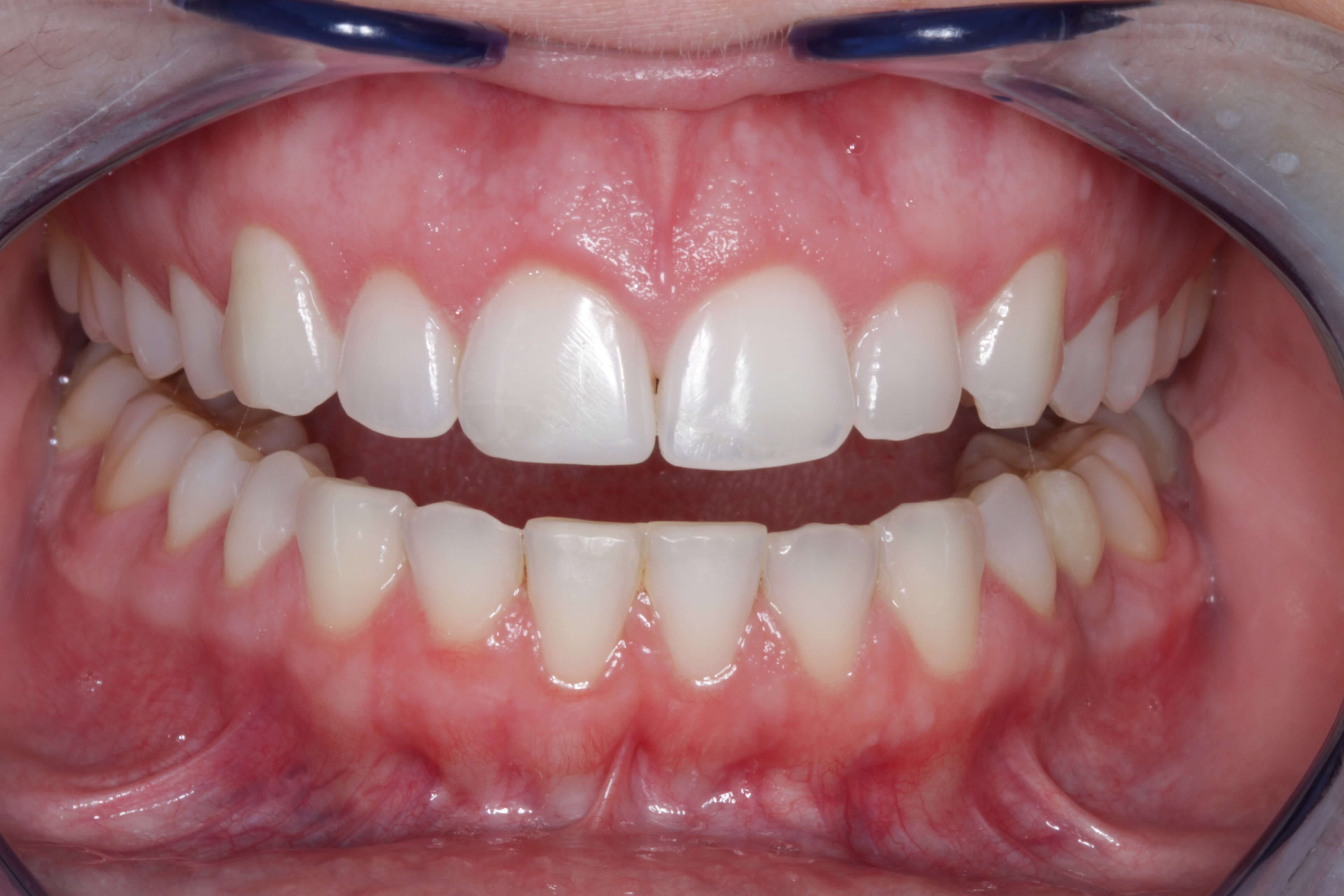 Before and After Photos After