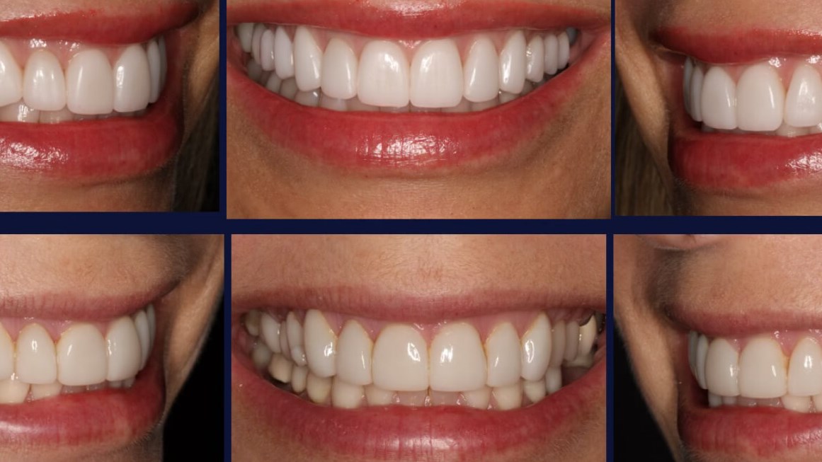 Veneers