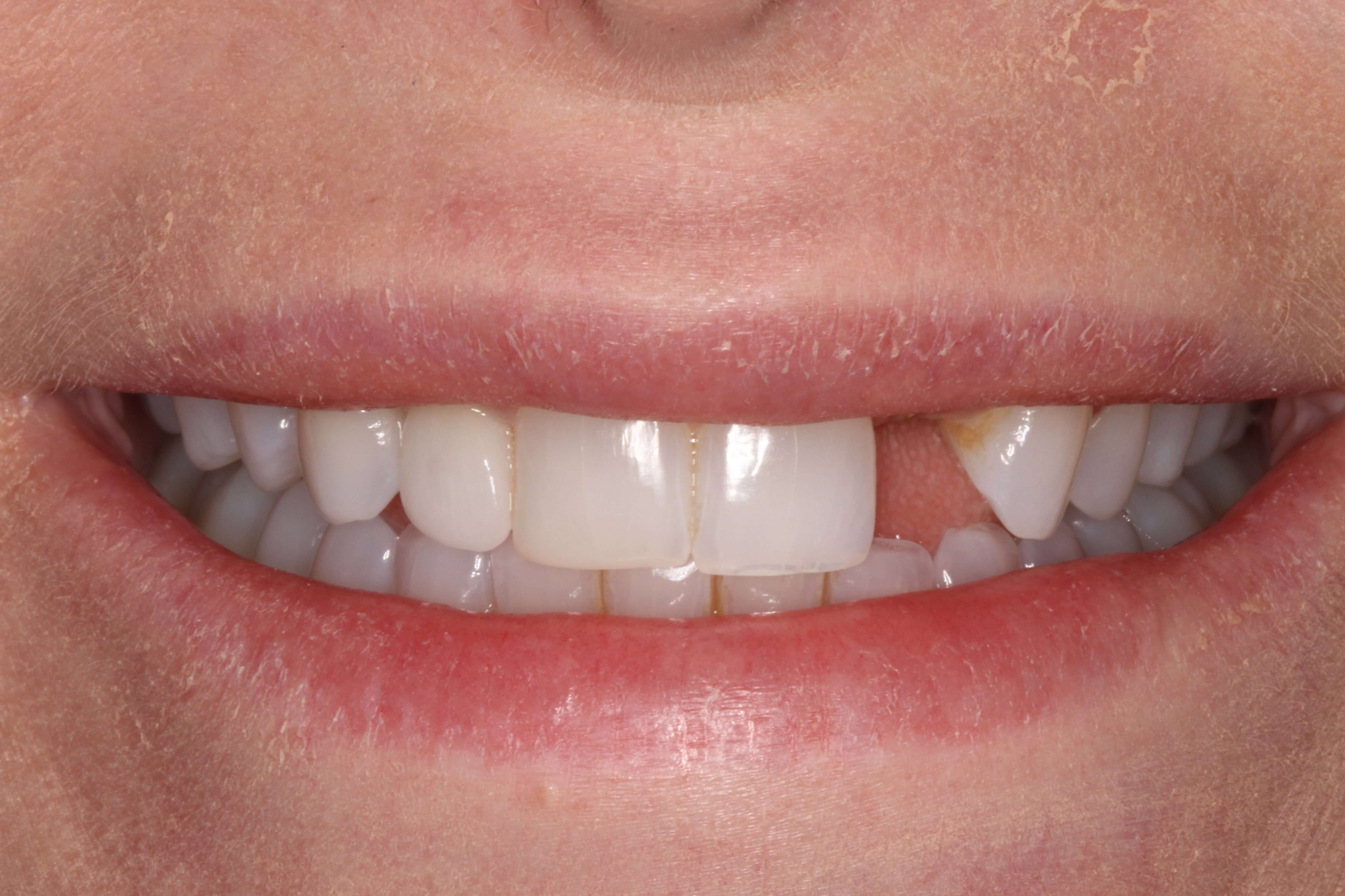 Before and After Photos Before