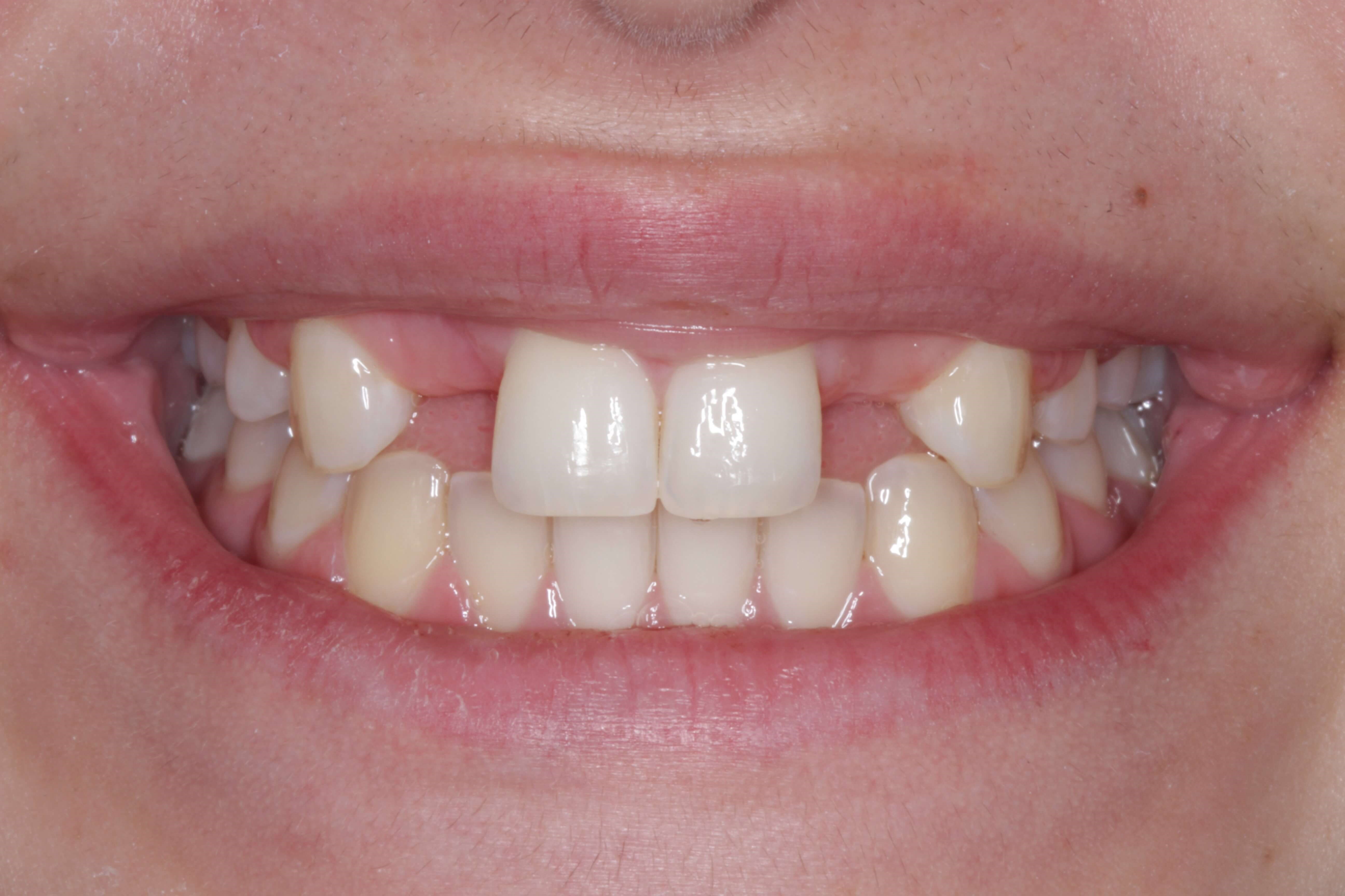 Smile Makeover After