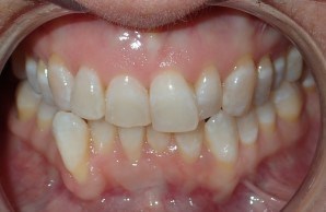 Smile Makeover Before Invisalign