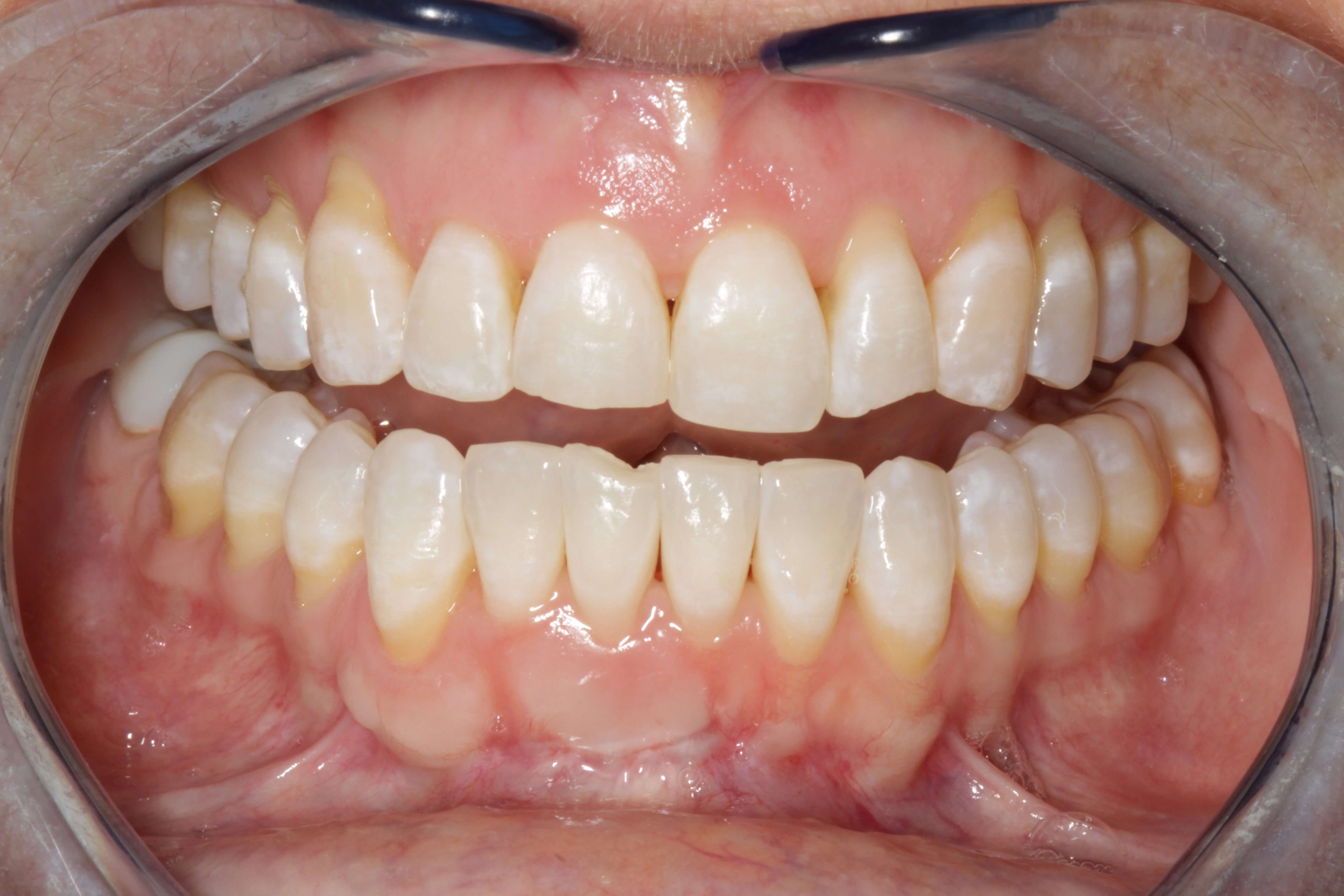 Smile Makeover Before Conservative Dentistry