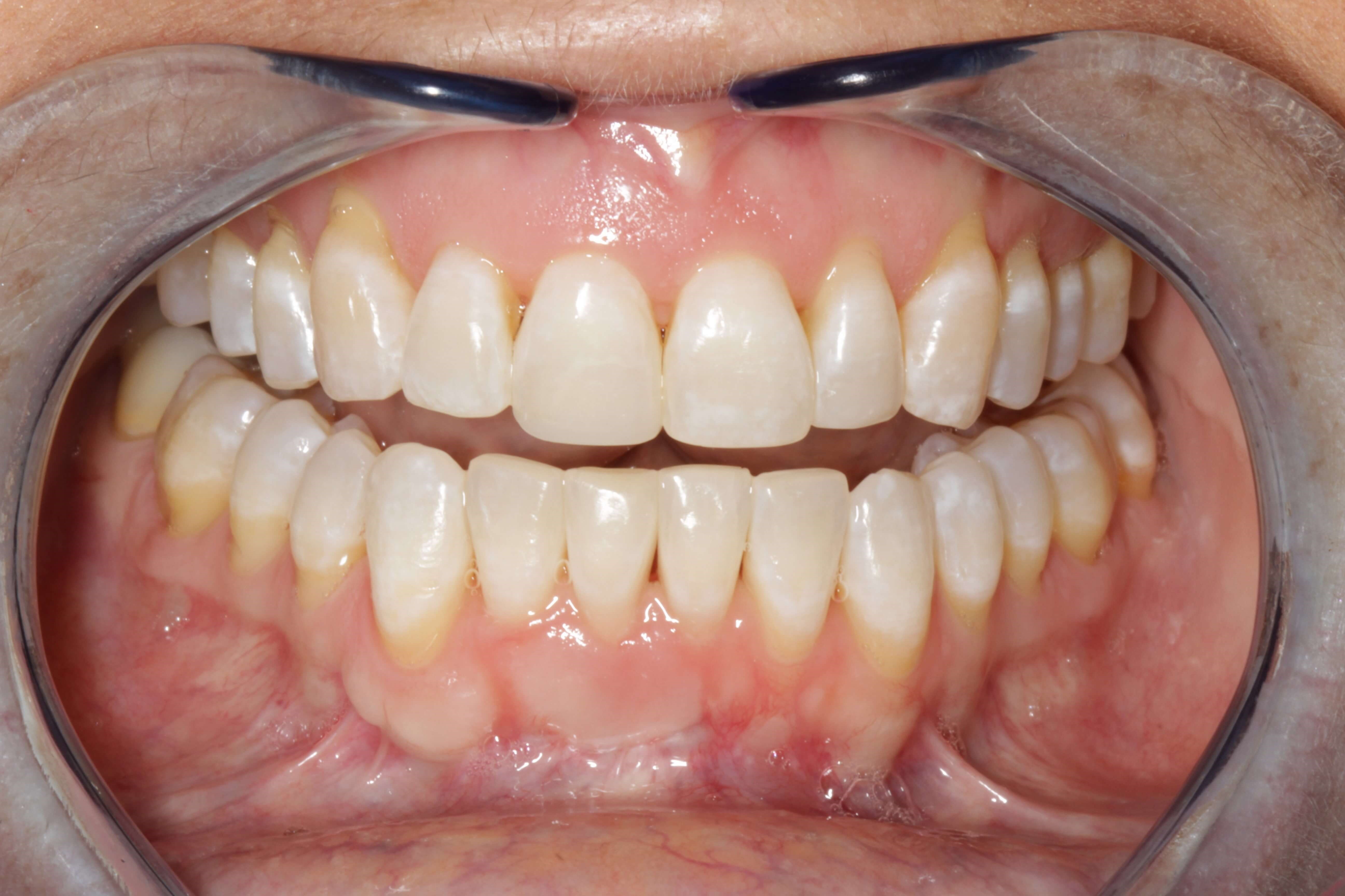 Smile Makeover After Cosmetic Enhancements