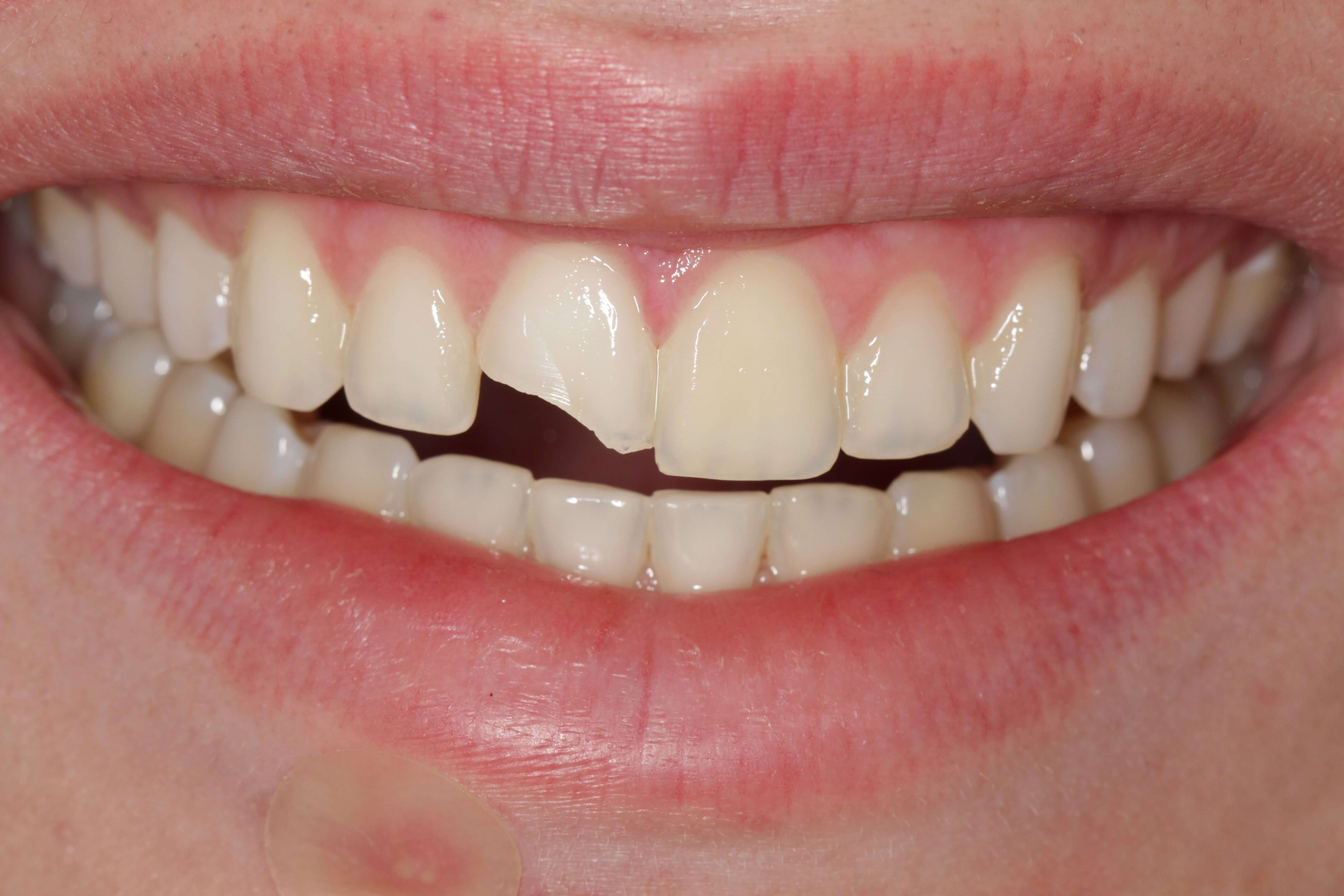Broken Front Tooth Before